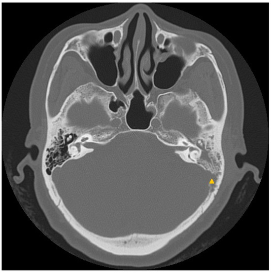 JCM | Free Full-Text | Mycobacterial Infection in Recalcitrant ...