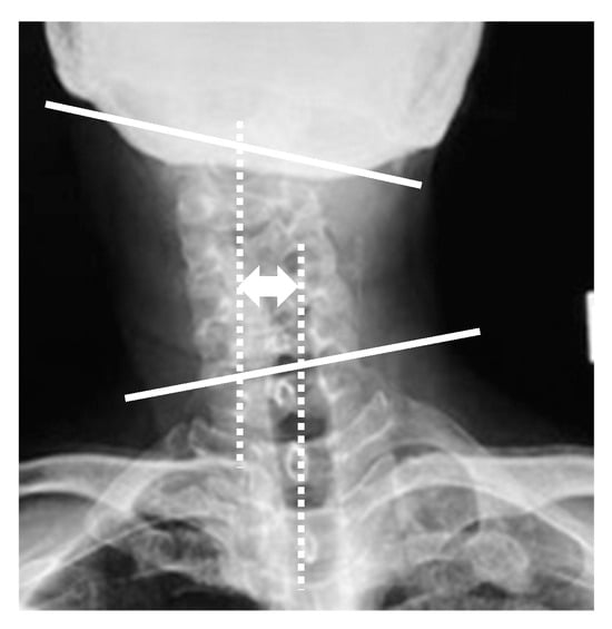 JCM | Free Full-Text | Clinical Results after Release of ...