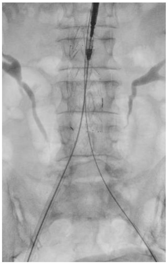 Contralateral Snare Cannulation vs. Retrograde Gate Cannulation during ...