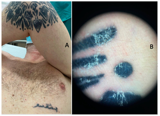 Figure 2 from [Allergic contact dermatitis to hydrocortisone as a  complication of tattoo care]. | Semantic Scholar