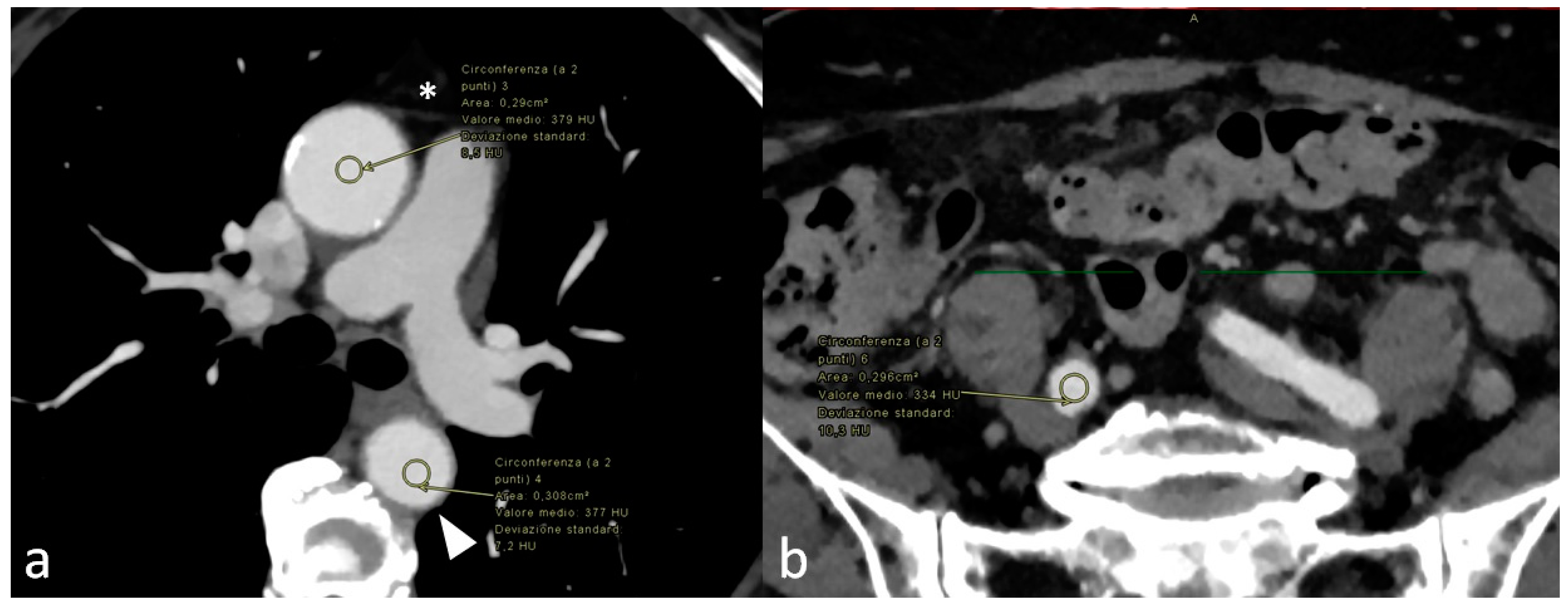 Reduction of contrast medium for transcatheter aortic valve replacement  planning using a spectral detector CT: a prospective clinical trial