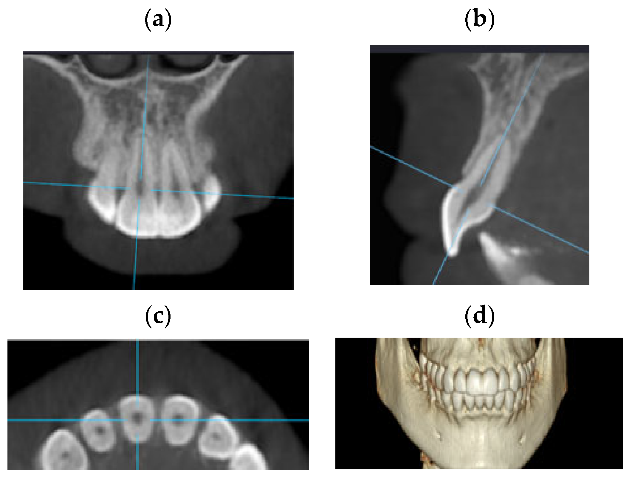 Jcm Free Full Text Diagnostic Accuracy Of Cone Beam Computed Tomography And Periapical