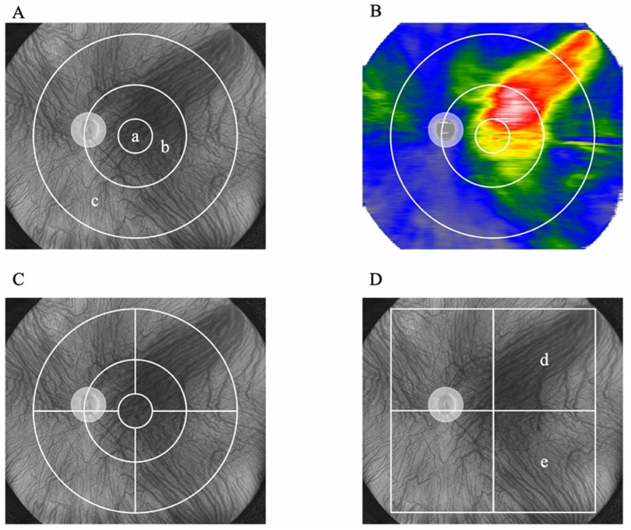 Jcm Free Full Text Wide Field Choroidal Thickness Analysis After Half Fluence Photodynamic 