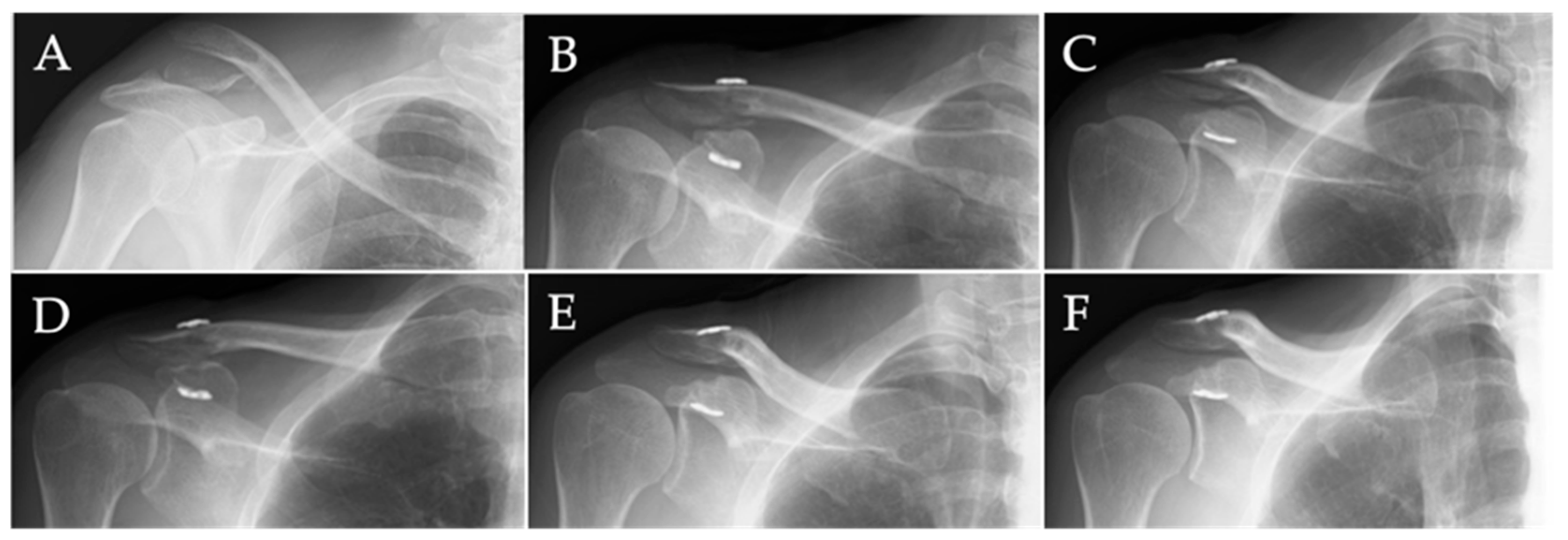 Arthroscopy Journal on X: The CC fixation method using multiple soft  anchor knots showed satisfactory results and had superior CC ligament  healing ability and maintenance of CC distance compared to hook fixation #