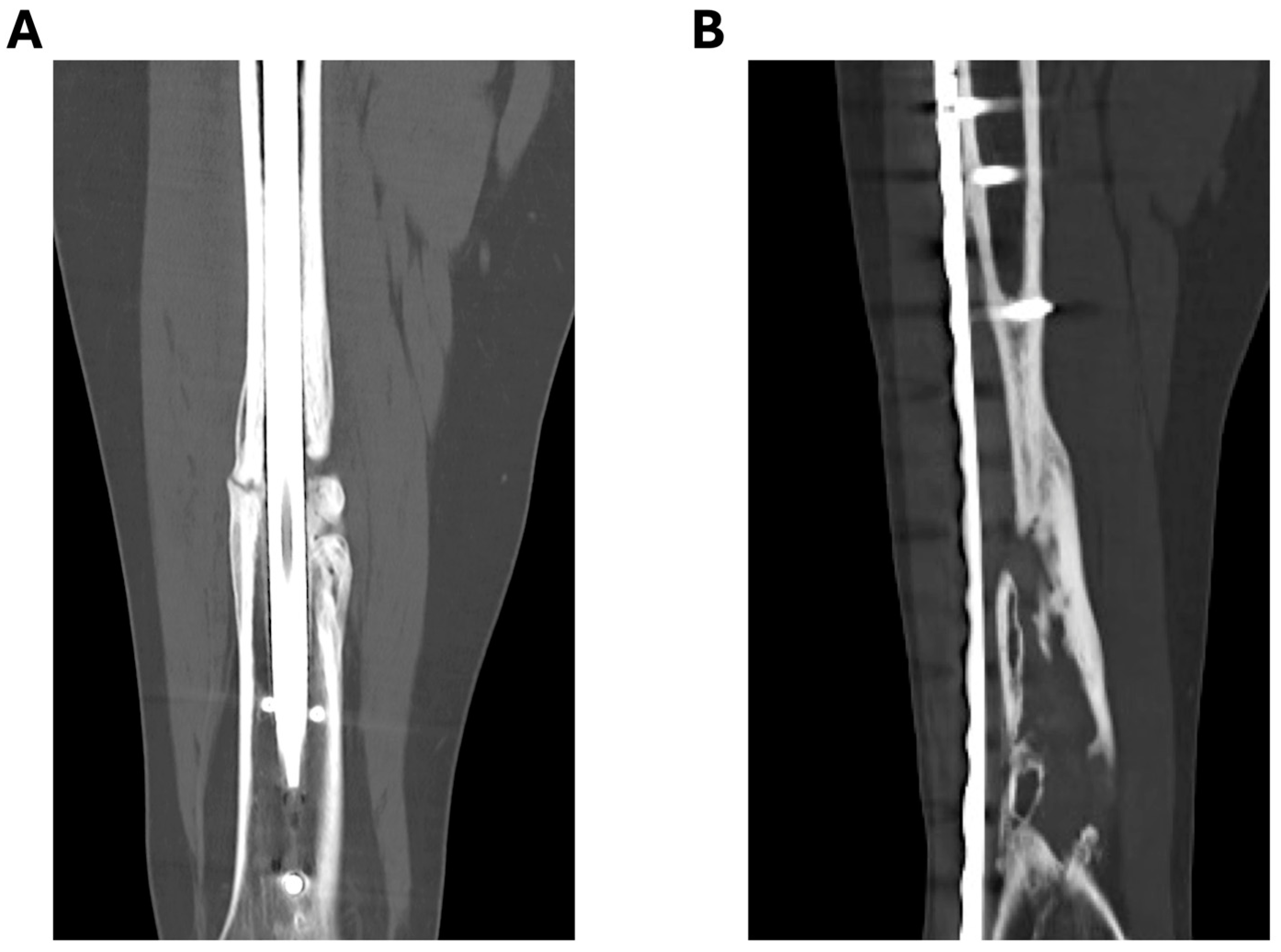 Preventing Atrophic Long Bone Nonunion Retrospective Analysis At A Preventing Atrophic Long Bone Nonunion Retrospective Analysis At A