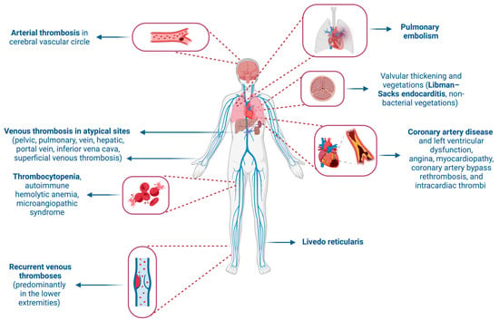 JCM | Free Full-Text | Management of Cardiovascular Complications in ...