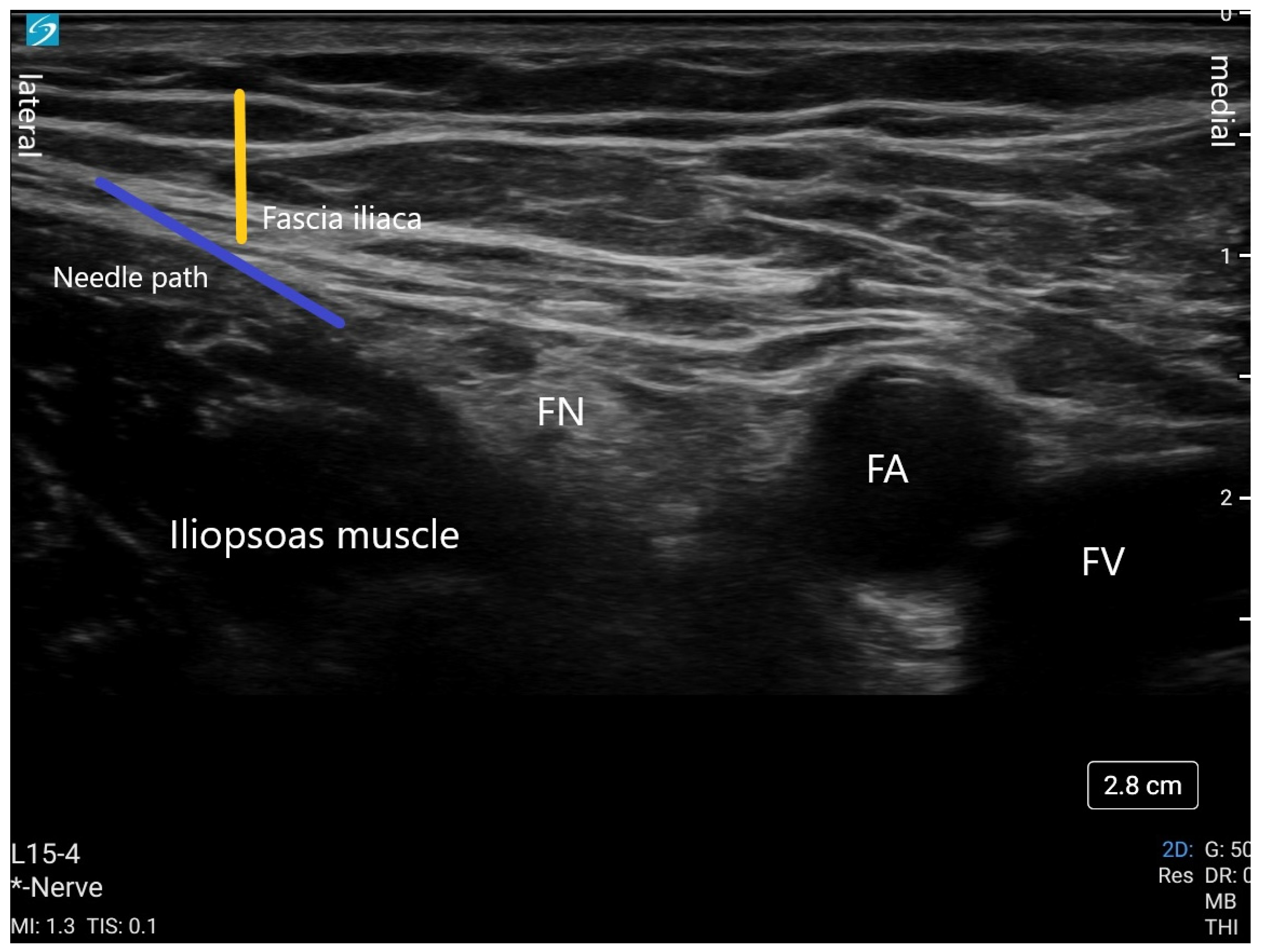 JCM | Free Full-Text | Peripheral Nerve Blocks for Hip Fractures