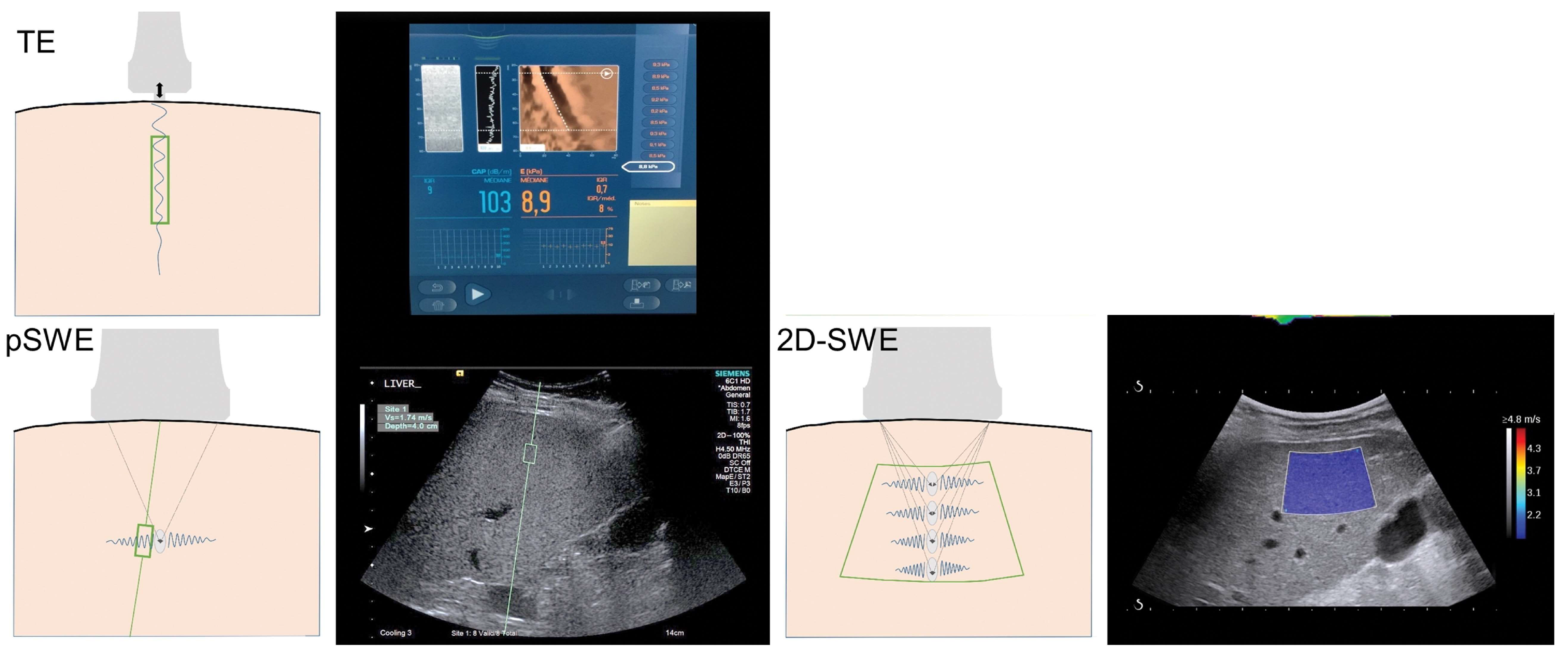 Shear Wave Ultrasound Elastography For Estimating Cartilage WKEB Shear Wave Ultrasound Elastography For Estimating Cartilage WKEB