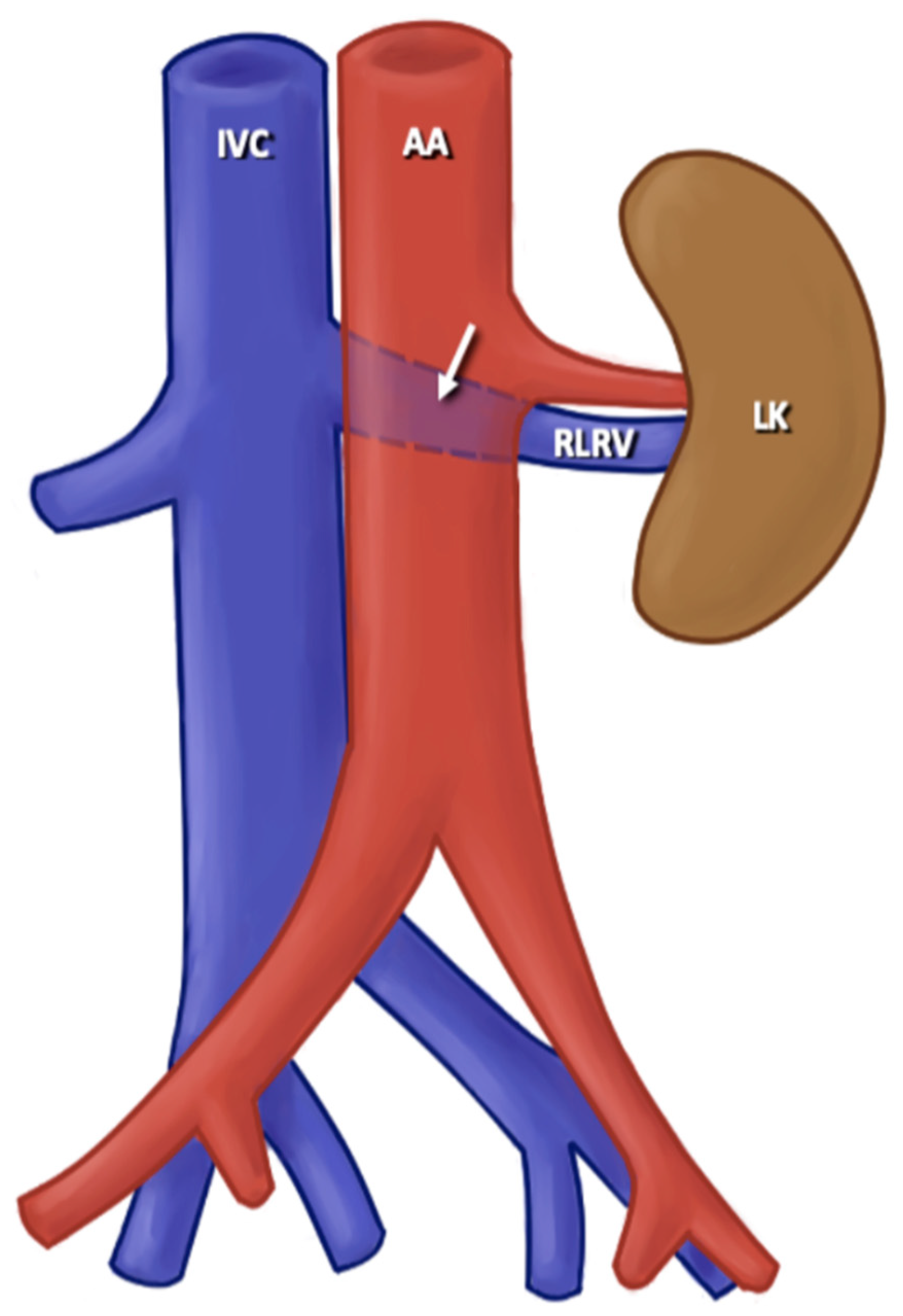 JCM | Free Full-Text | Anatomical Variants of the Renal Veins and Their ...