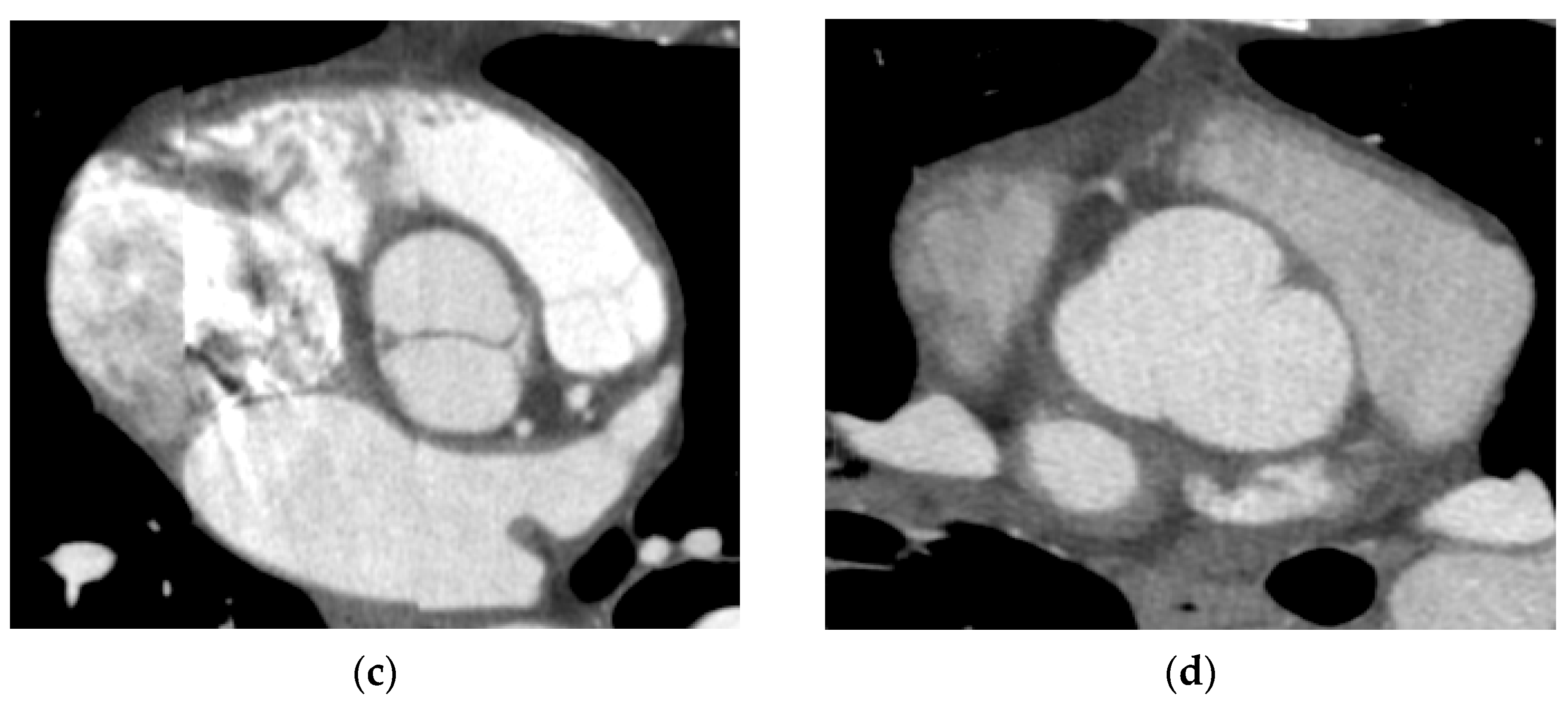 JCM | Free Full-Text | Patients with a Bicuspid Aortic Valve (BAV ...