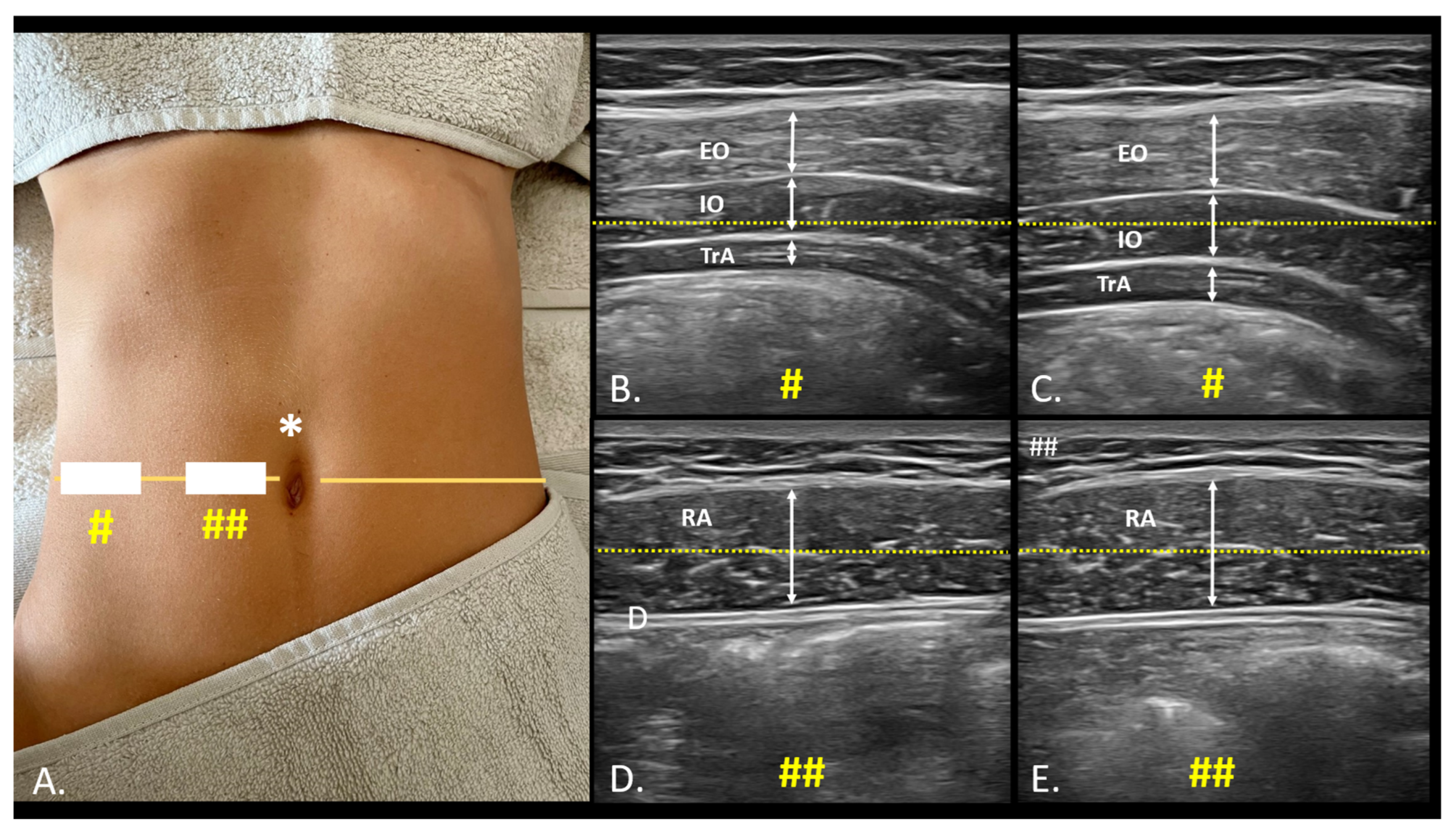 JCM | Free Full-Text | Evaluation of Abdominal Musculature Thickness ...