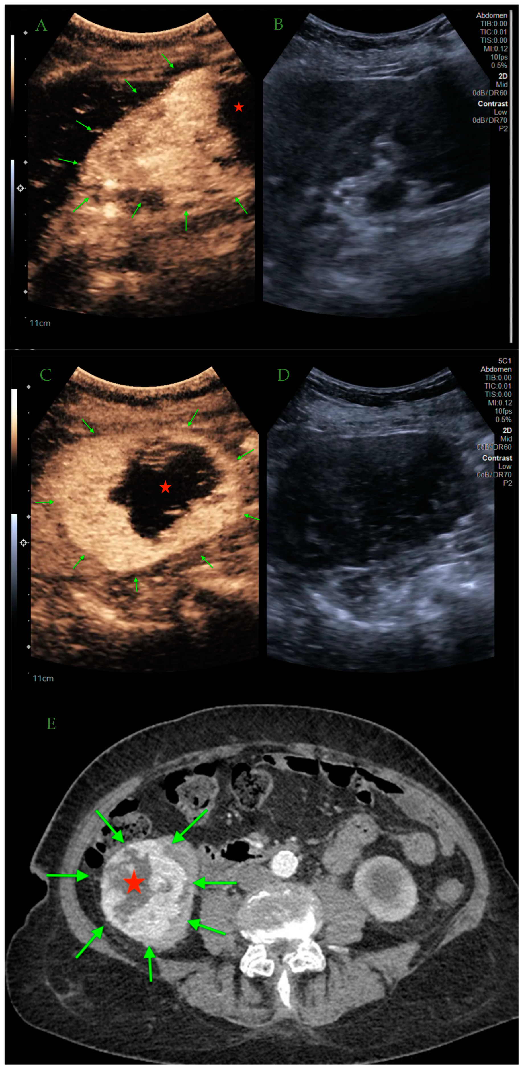 Contrast Enhanced Ultrasound In The Diagnosis Of Solid Renal Lesions Contrast Enhanced Ultrasound In The Diagnosis Of Solid Renal Lesions