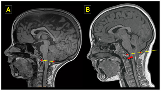 JCM Free Full Text Surgical Outcomes in Chiari 1 and Chiari 1 5  