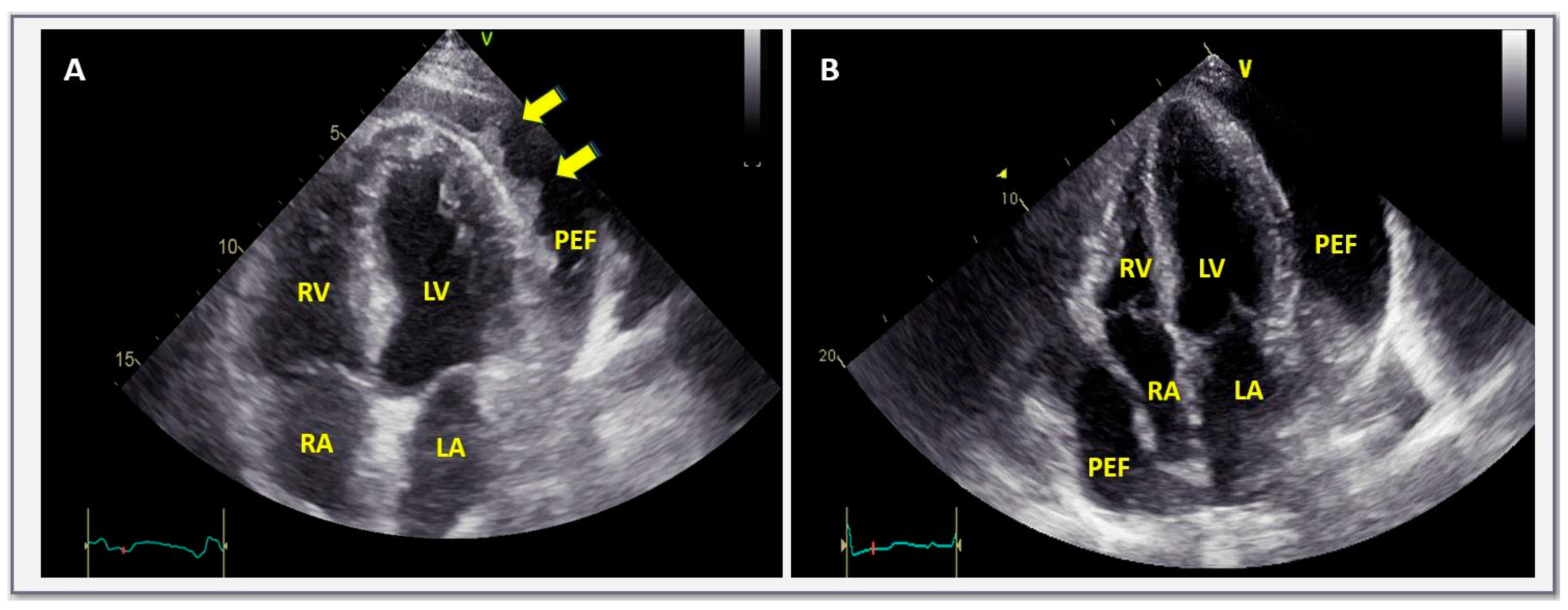 Asymptomatic Chronic Large Pericardial Effusions: To Drain or to Observe?