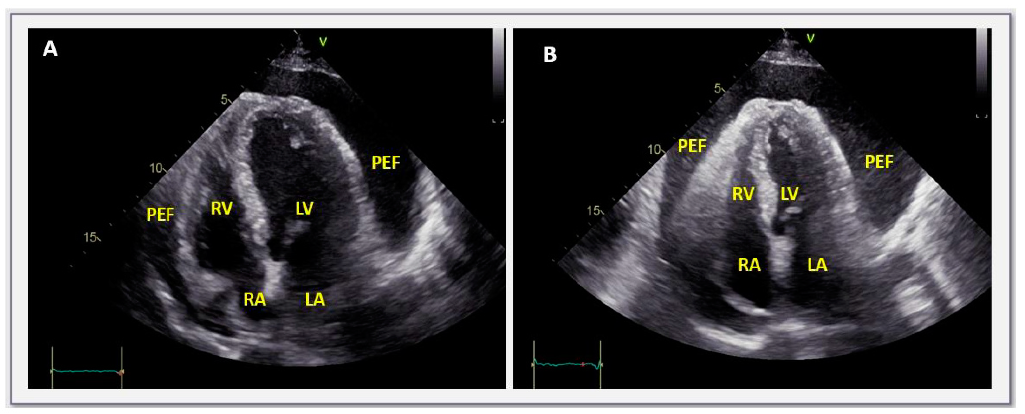 Asymptomatic Chronic Large Pericardial Effusions: To Drain or to Observe?