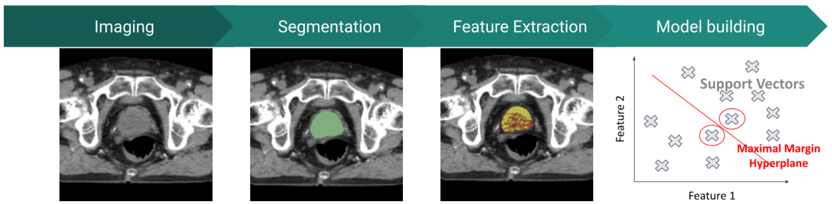 JCM | Free Full-Text | Radiomic Pipelines for Prostate Cancer in ...