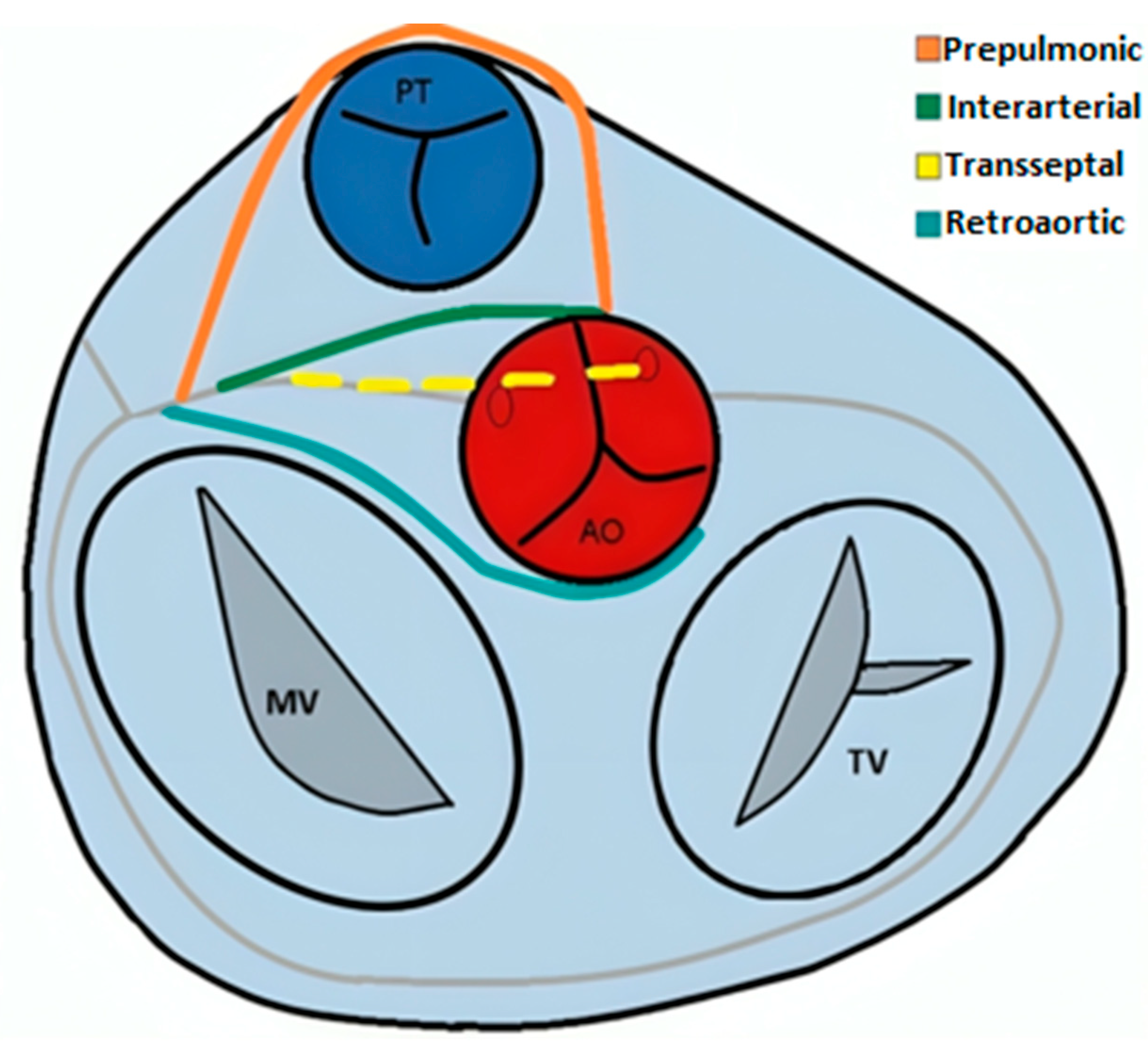 JCM | Free Full-Text | Coronary Artery Anomalies: A Computed Tomography ...