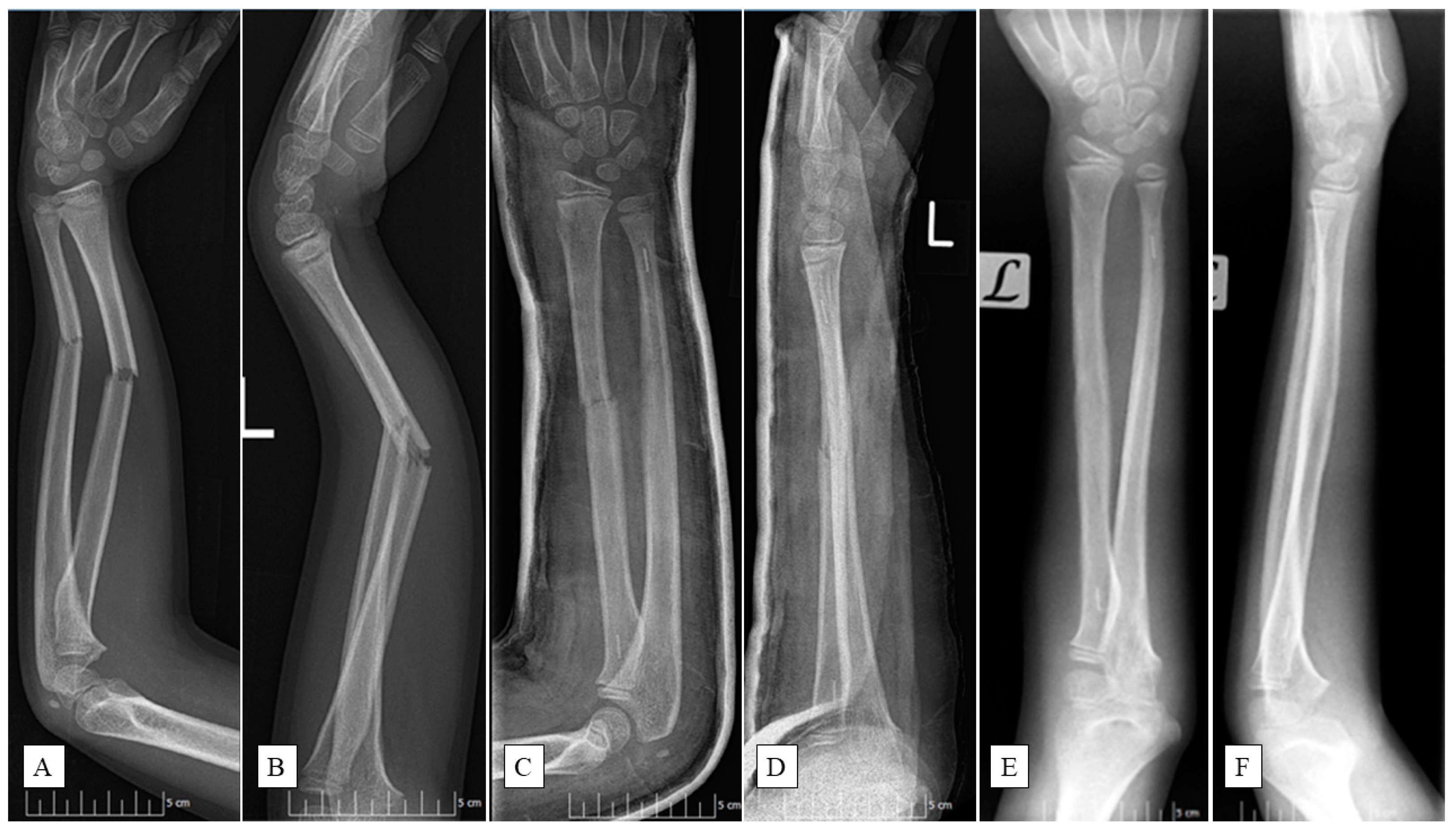 JCM | Free Full-Text | Pediatric Diaphyseal Forearm Fracture Management ...