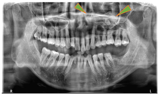 JCM | Free Full-Text | A Unique Case of Supernumerary Teeth Erupting ...