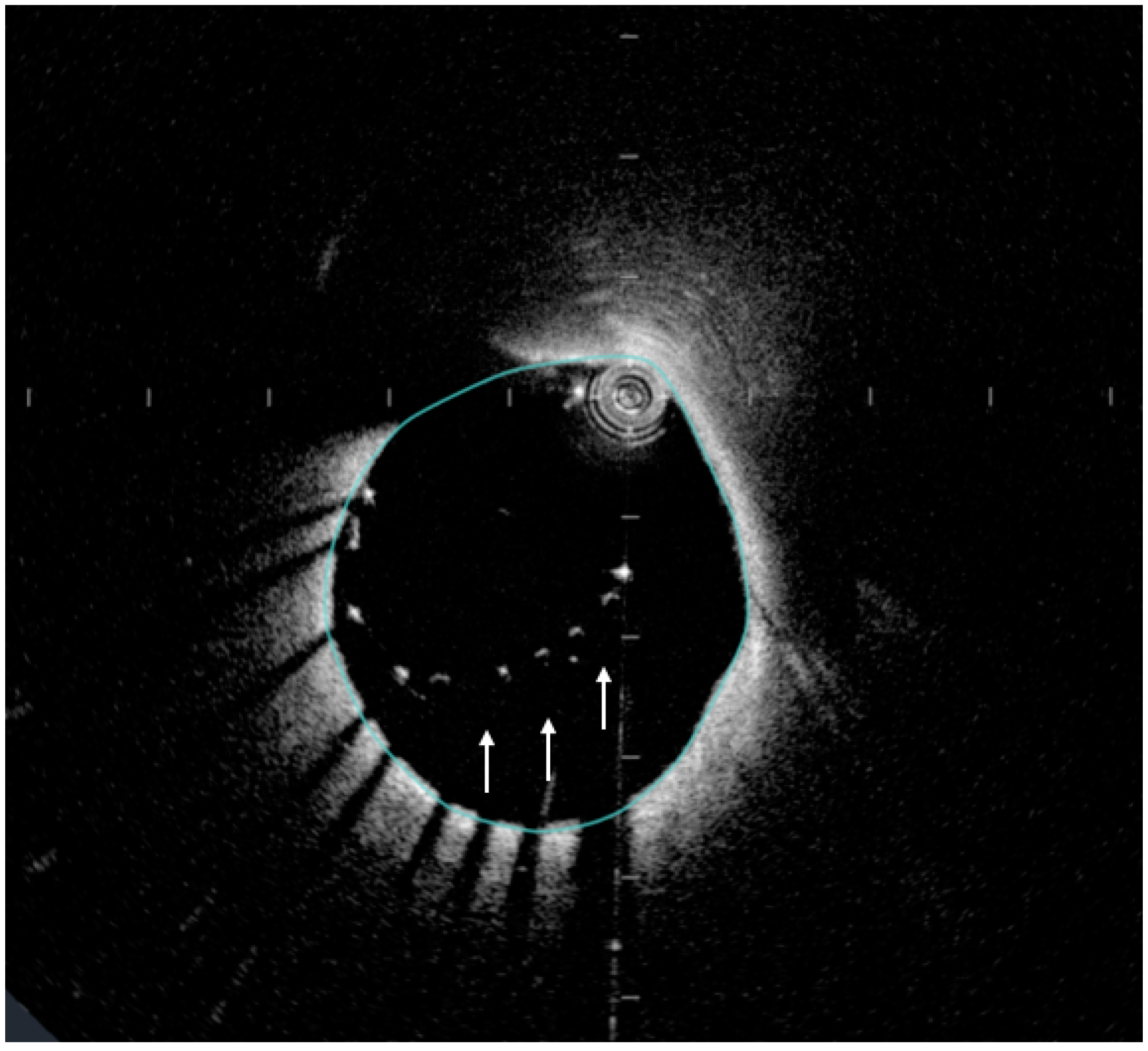 JCM | Free Full-Text | Innovations In Intracoronary Imaging: Present ...