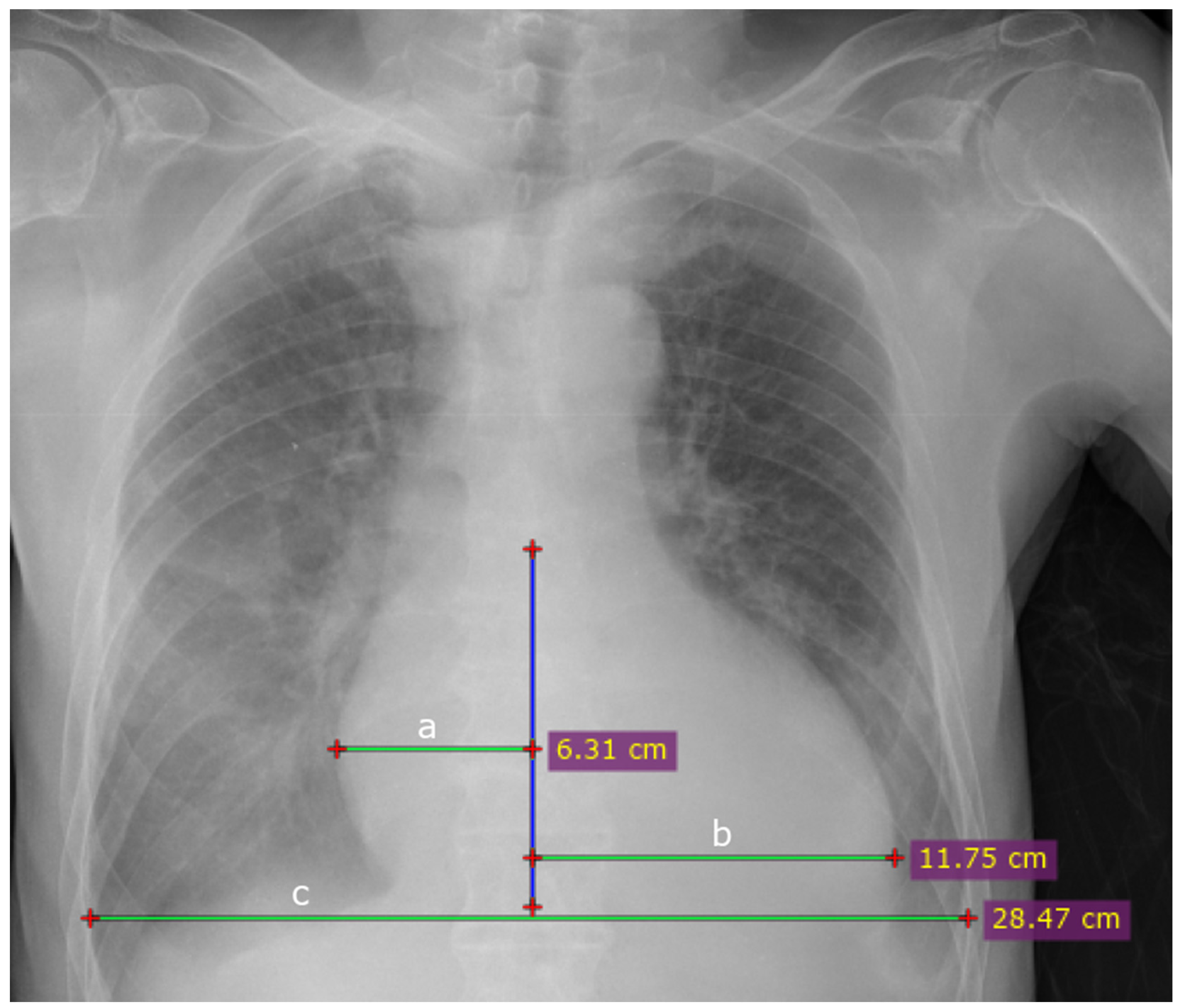 Deep Learning In Cardiothoracic Ratio Calculation And Cardiomegaly Deep Learning In Cardiothoracic Ratio Calculation And Cardiomegaly
