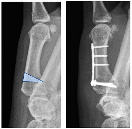 Metacarpian Rx Three-Dimensional Analysis of the First Metacarpal Axes in Healthy ...