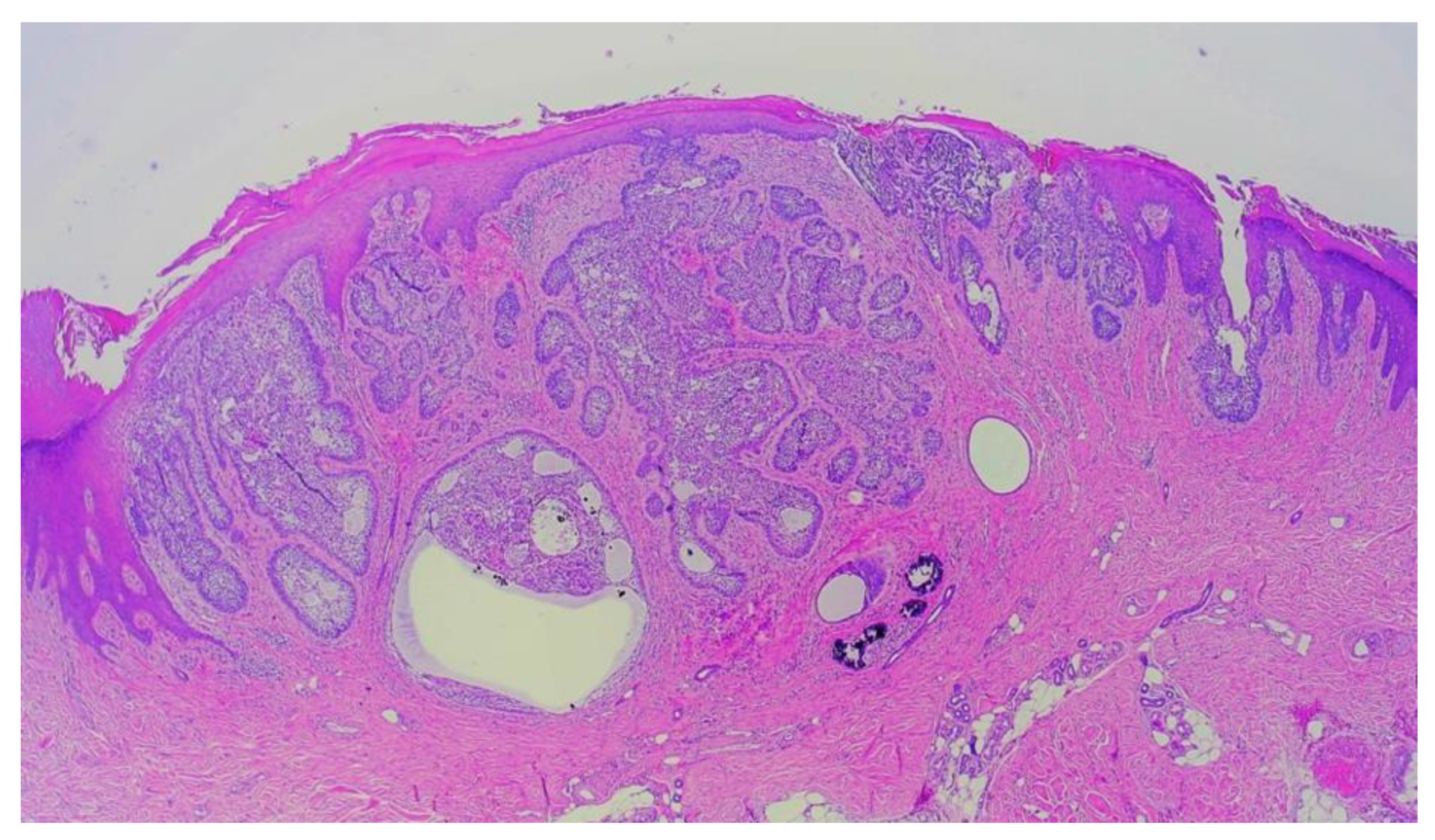 The Application Of Mohs Micrographic Surgery In The Treatment Of Acral Basal Cell Carcinoma A