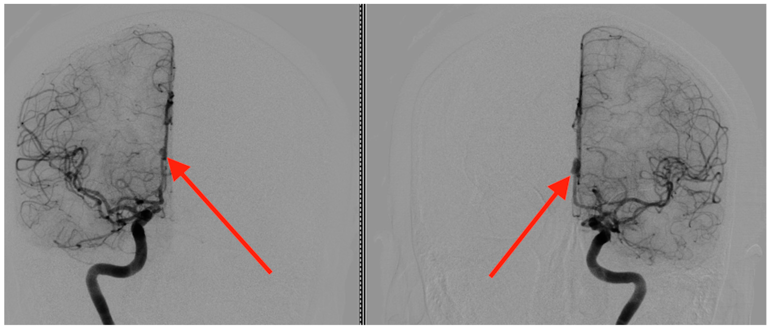 Mirror Aneurysms of the Pericallosal Artery Clipped During a Single ...