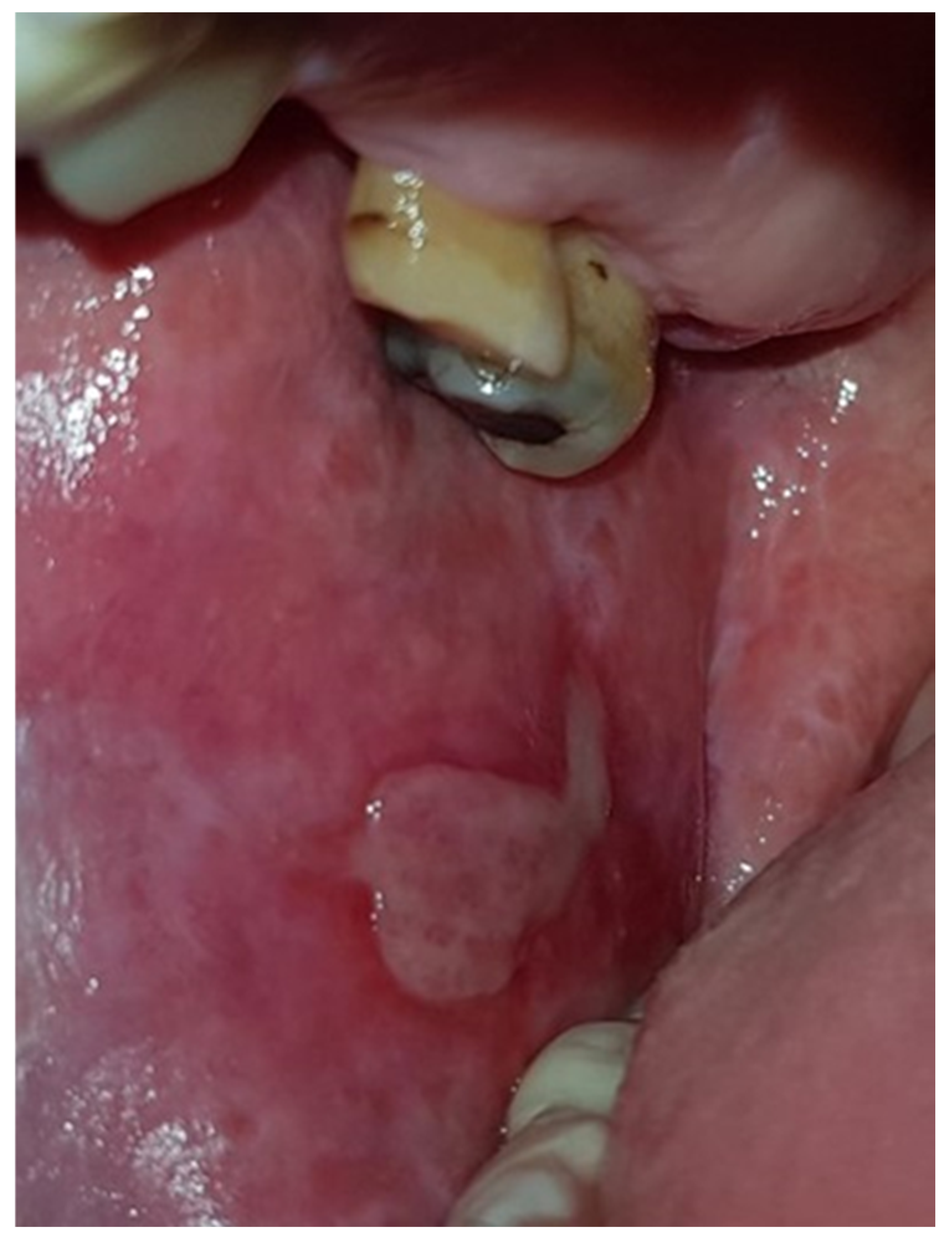 Oral Lichen Planus Clinical Presentation Demographic Characteristics Oral Lichen Planus Clinical Presentation Demographic Characteristics