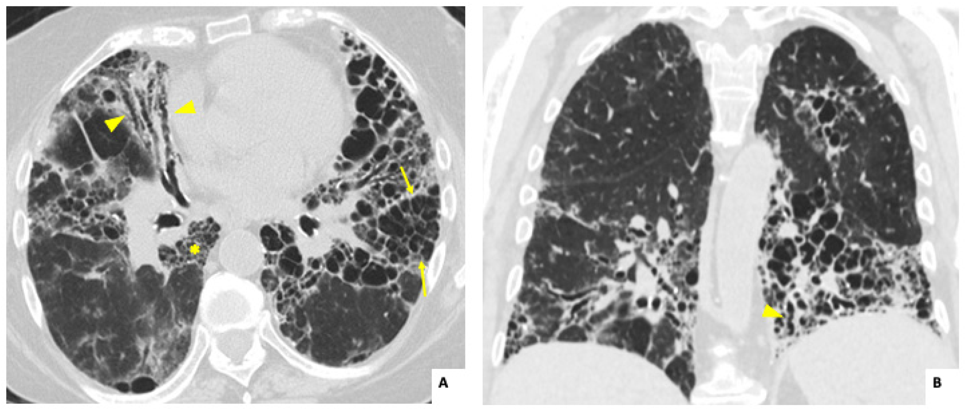 Clinical Profiles, Survival, And Lung Function Outcomes In Anca 