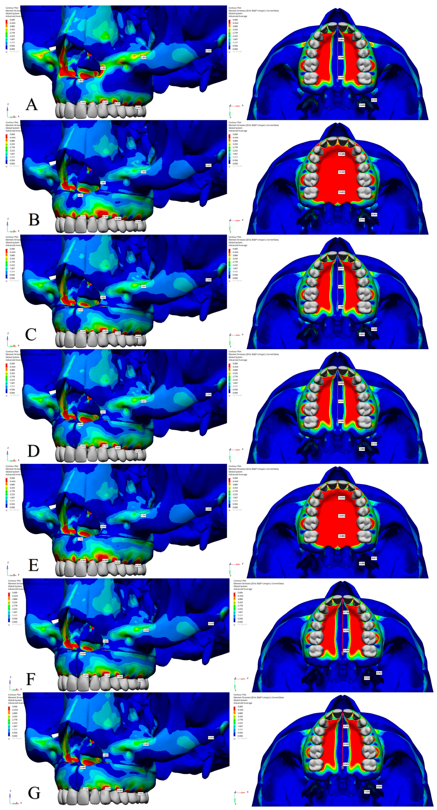 Stress And Displacement Dynamics In Surgically Assisted Rapid Maxillary 