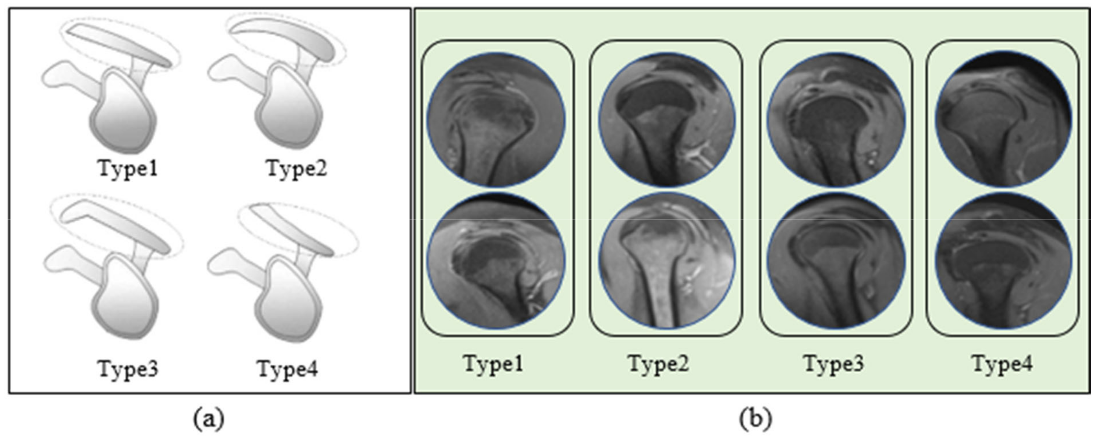 Detection of Acromion Types in Shoulder Magnetic Resonance Image ...