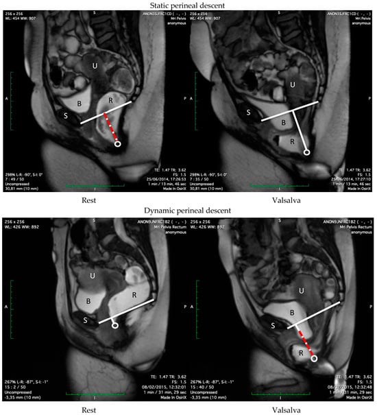 Evaluation of Perineal Descent Measurements on Pelvic Floor Imaging