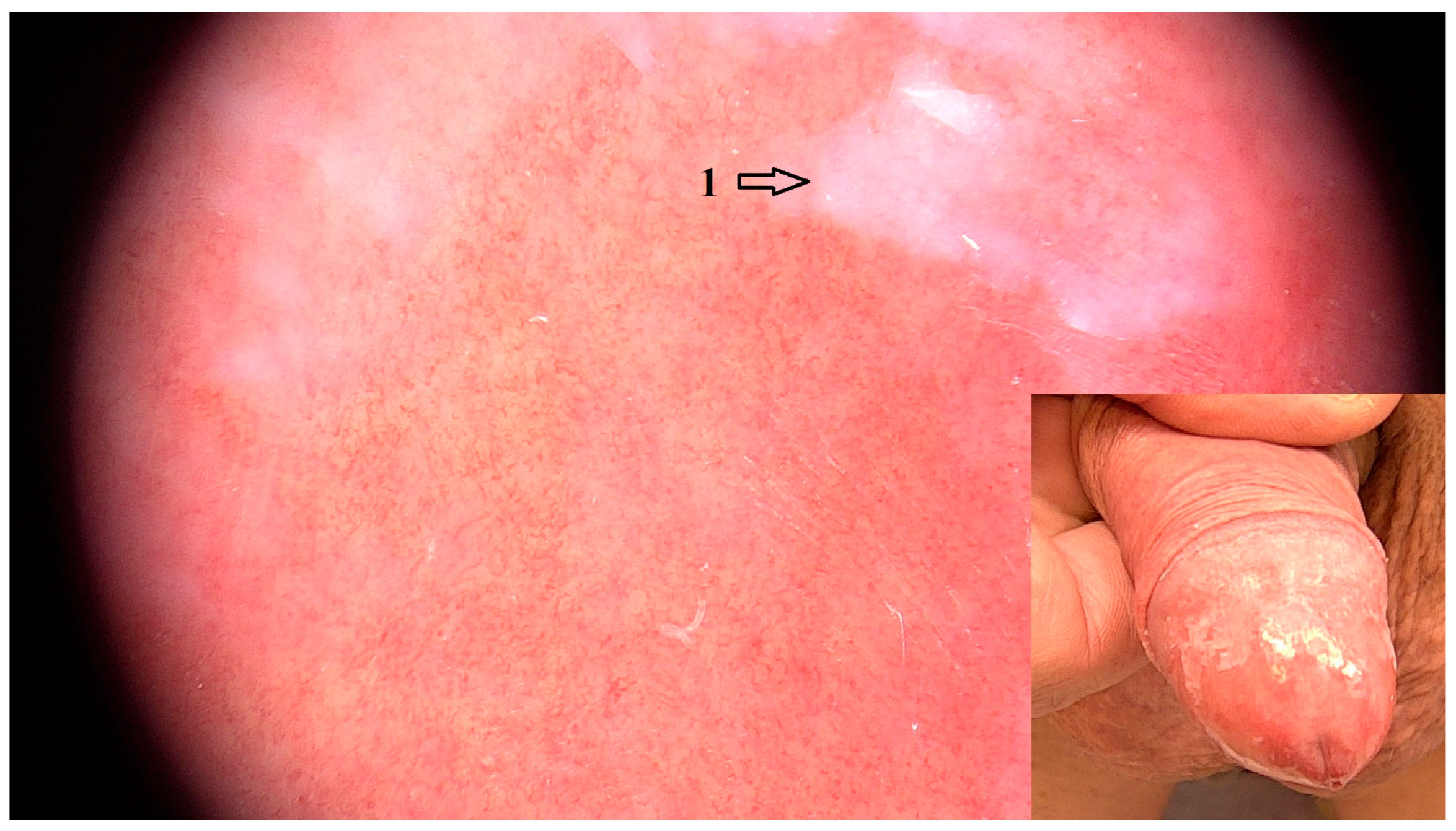 Dermoscopic Features of Non-Infectious Balanoposthitis