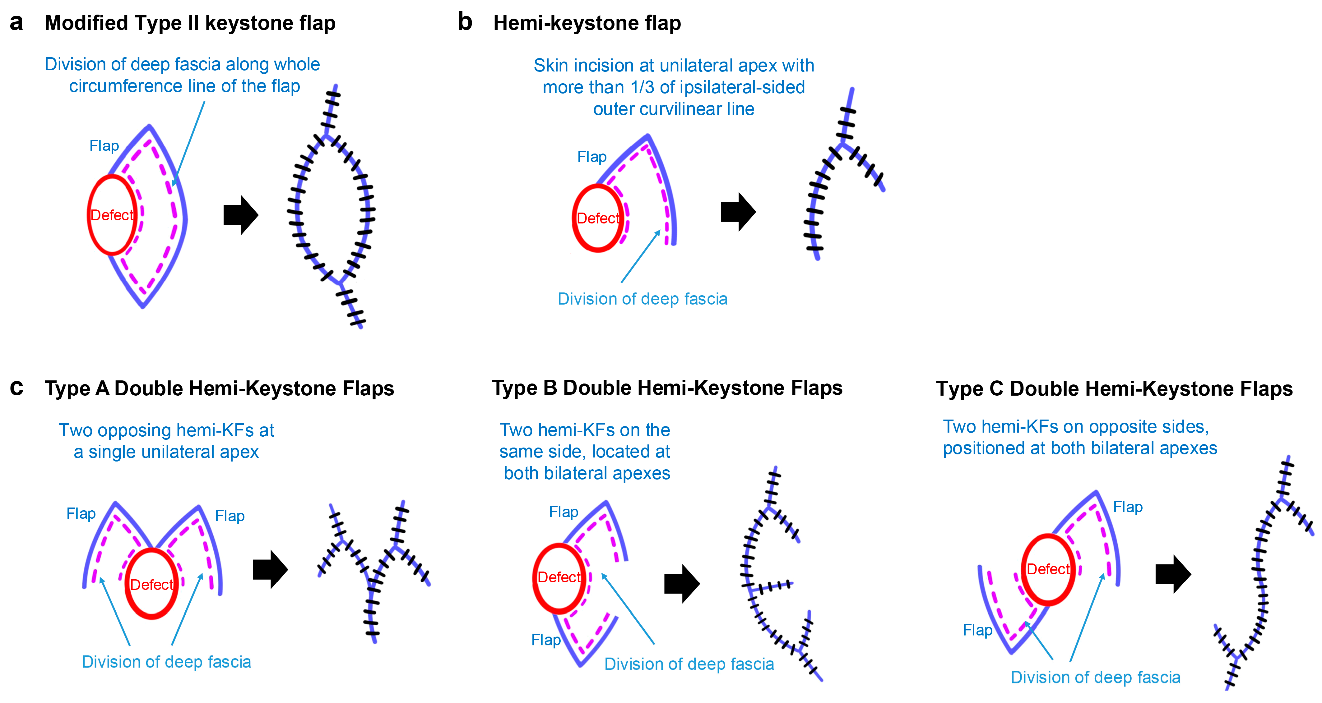 Patient and Observer Scar Assessment of Facial Keystone Flap ...