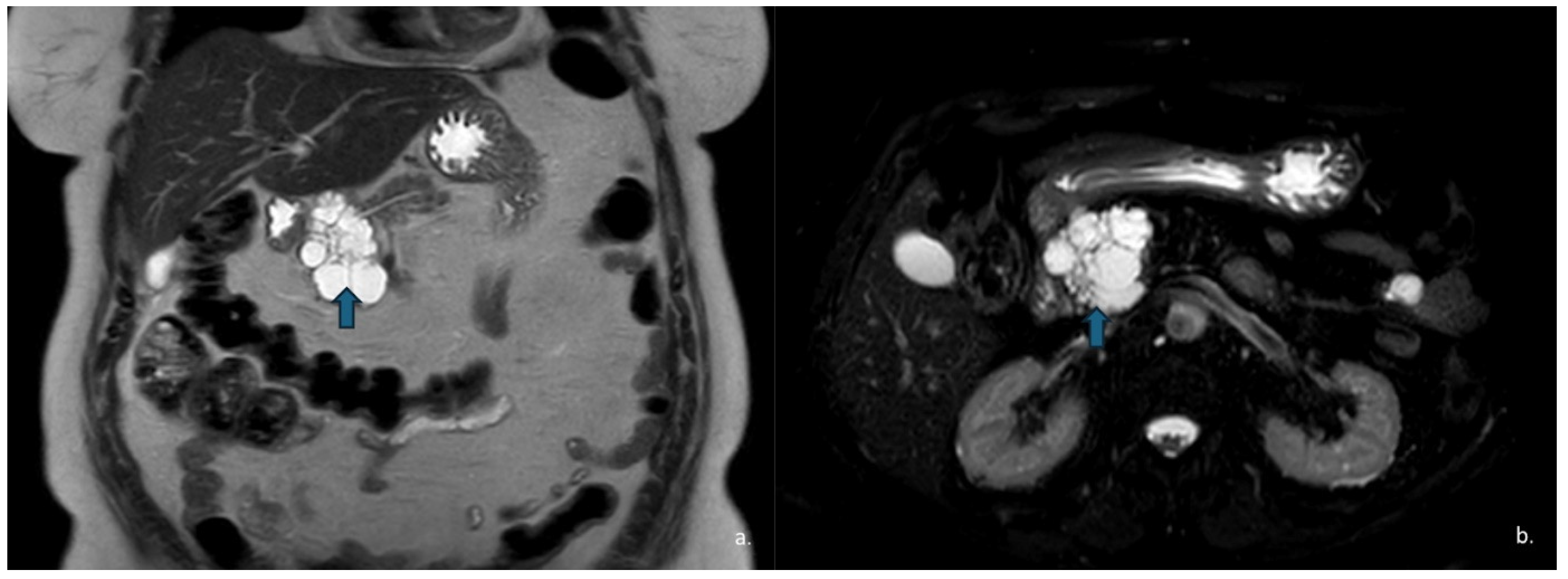 Pancreatic Cystic Lesions: From Basic Knowledge to Recent Guidelines