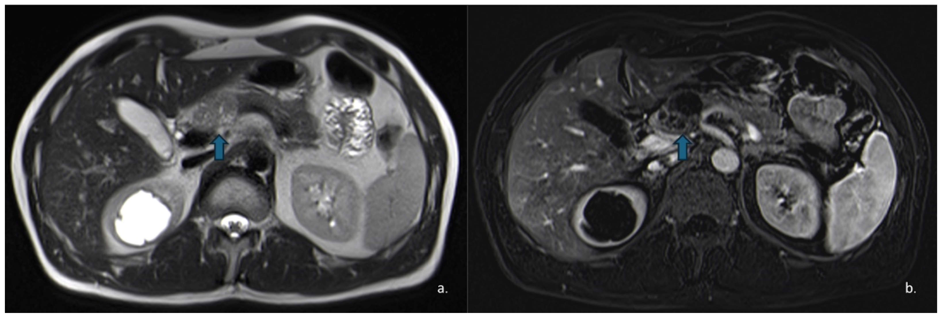 Pancreatic Cystic Lesions: From Basic Knowledge to Recent Guidelines