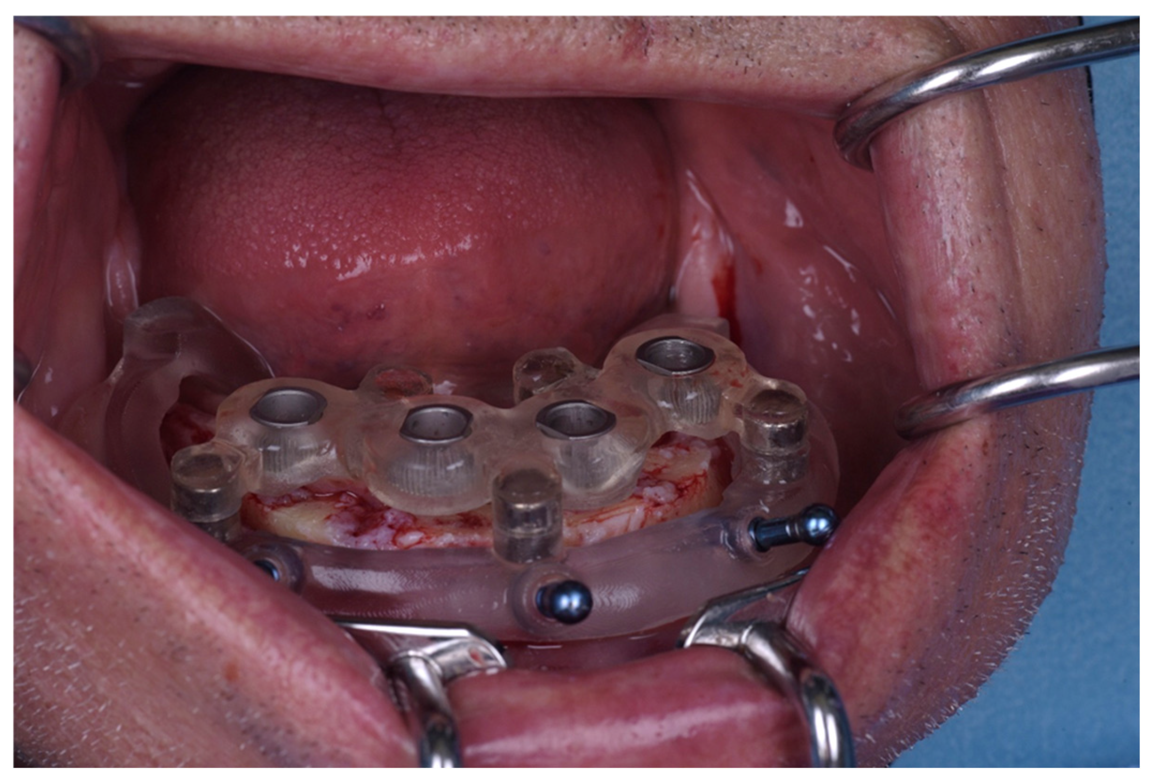 Accuracy of Fully Guided Implant Placement Using Bone-Supported ...