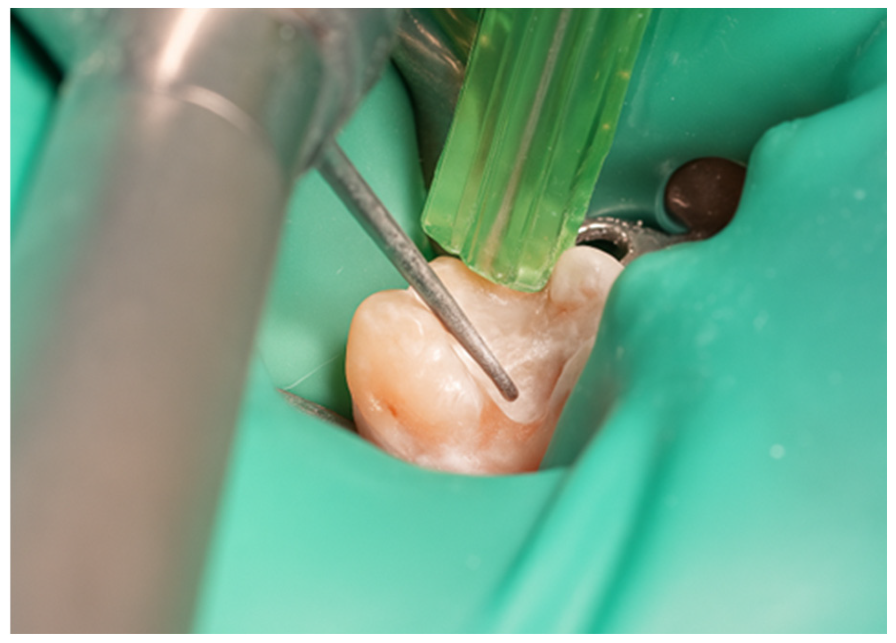 Direct and Semi-Direct Composite Techniques in Posterior Teeth: A Two ...
