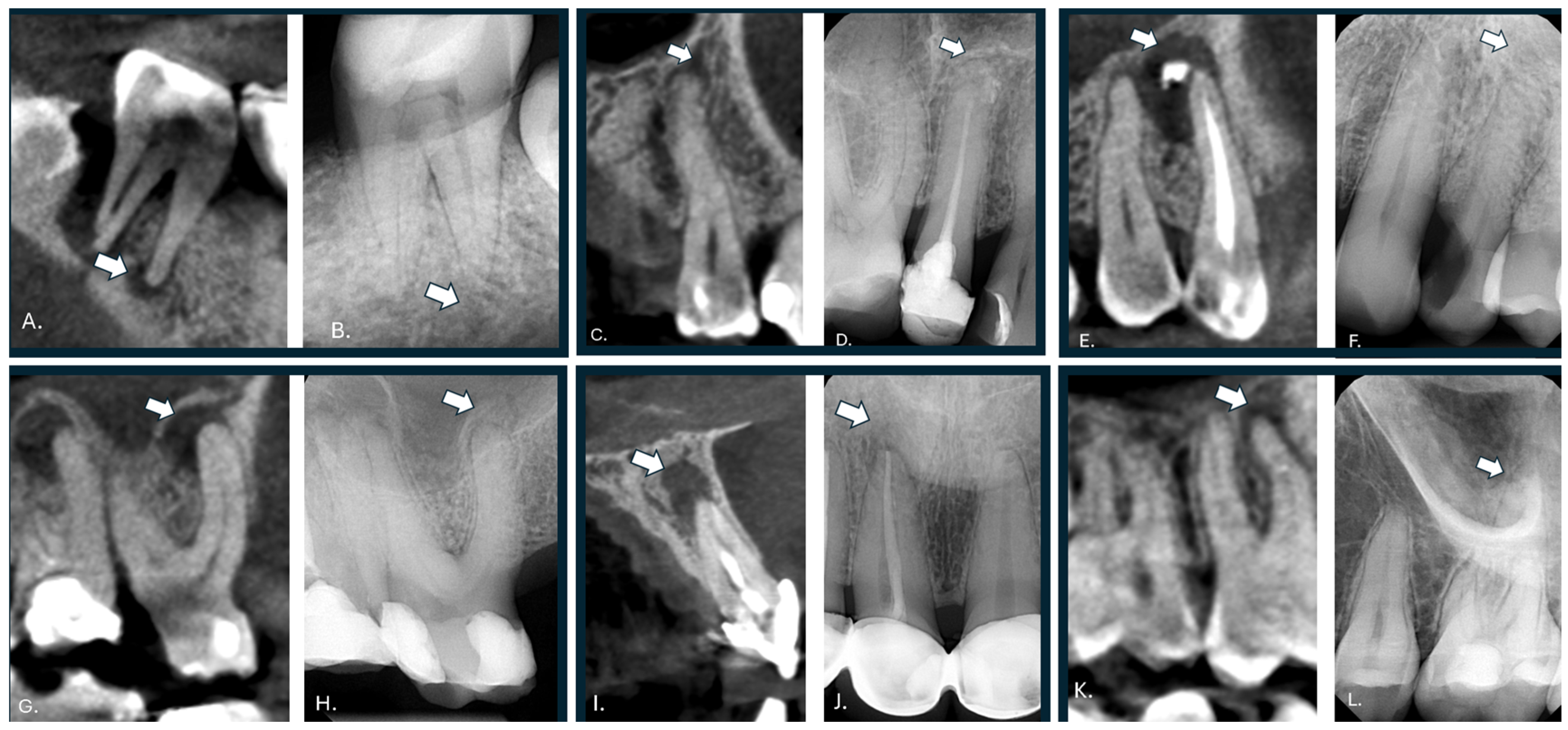 Periapical Radiopacity Classification Radiomics as a Decision Support Tool for Detecting Occult Periapical ...