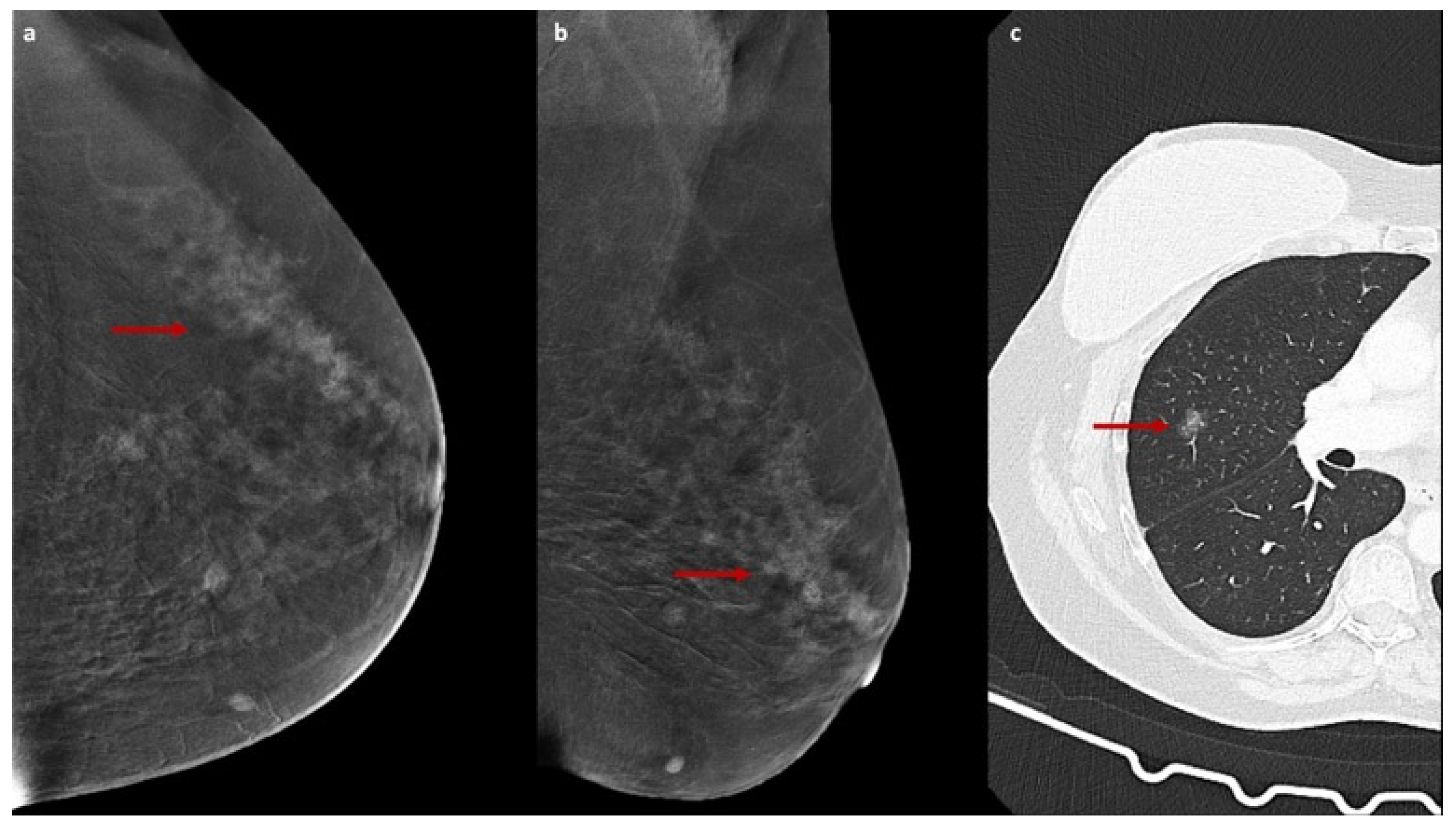 ground-glass-enhancement-on-contrast-enhanced-mammography-a-ct