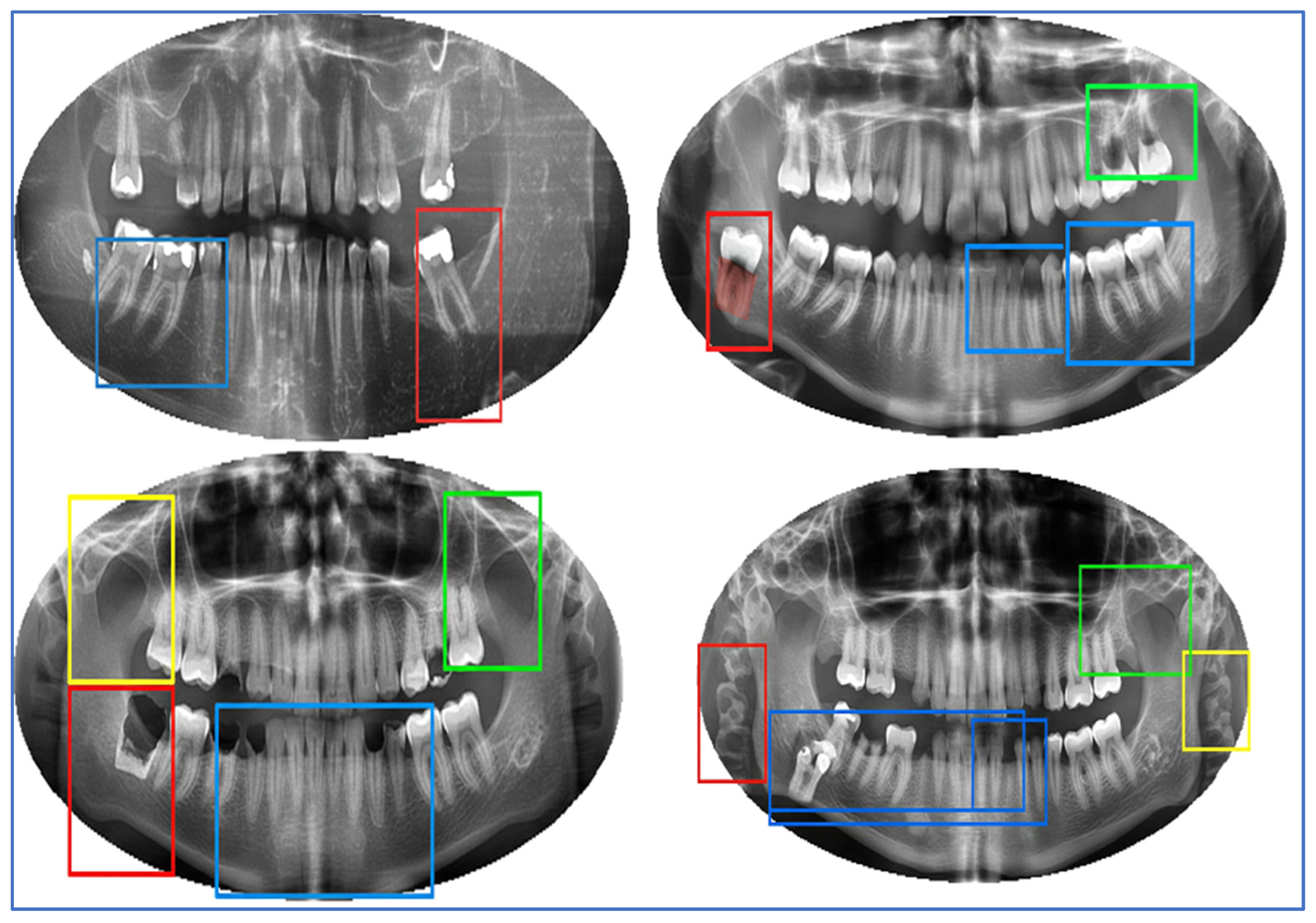 A Hybrid Deep Learning Framework for Automated Dental Disorder ...