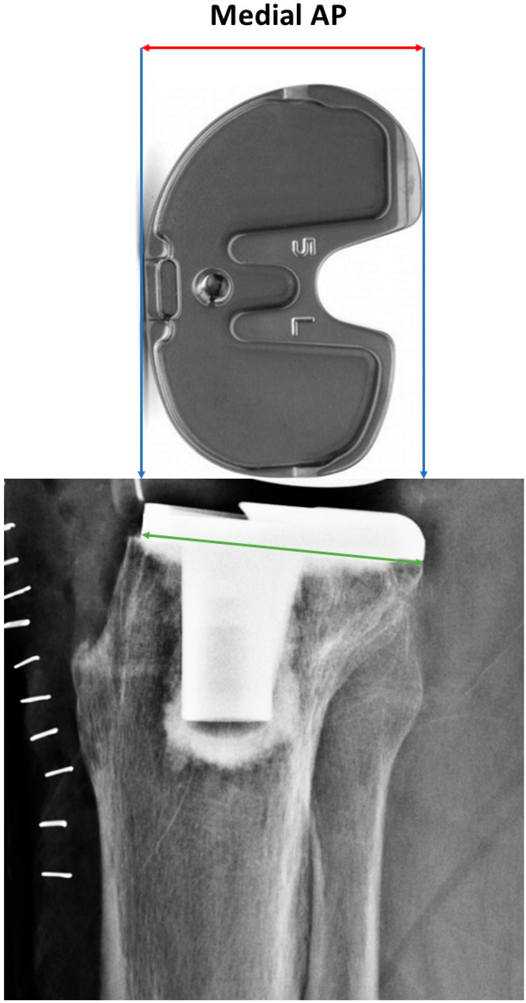 Radiographic Verification of the Feasibility of Intramedullary Nailing ...