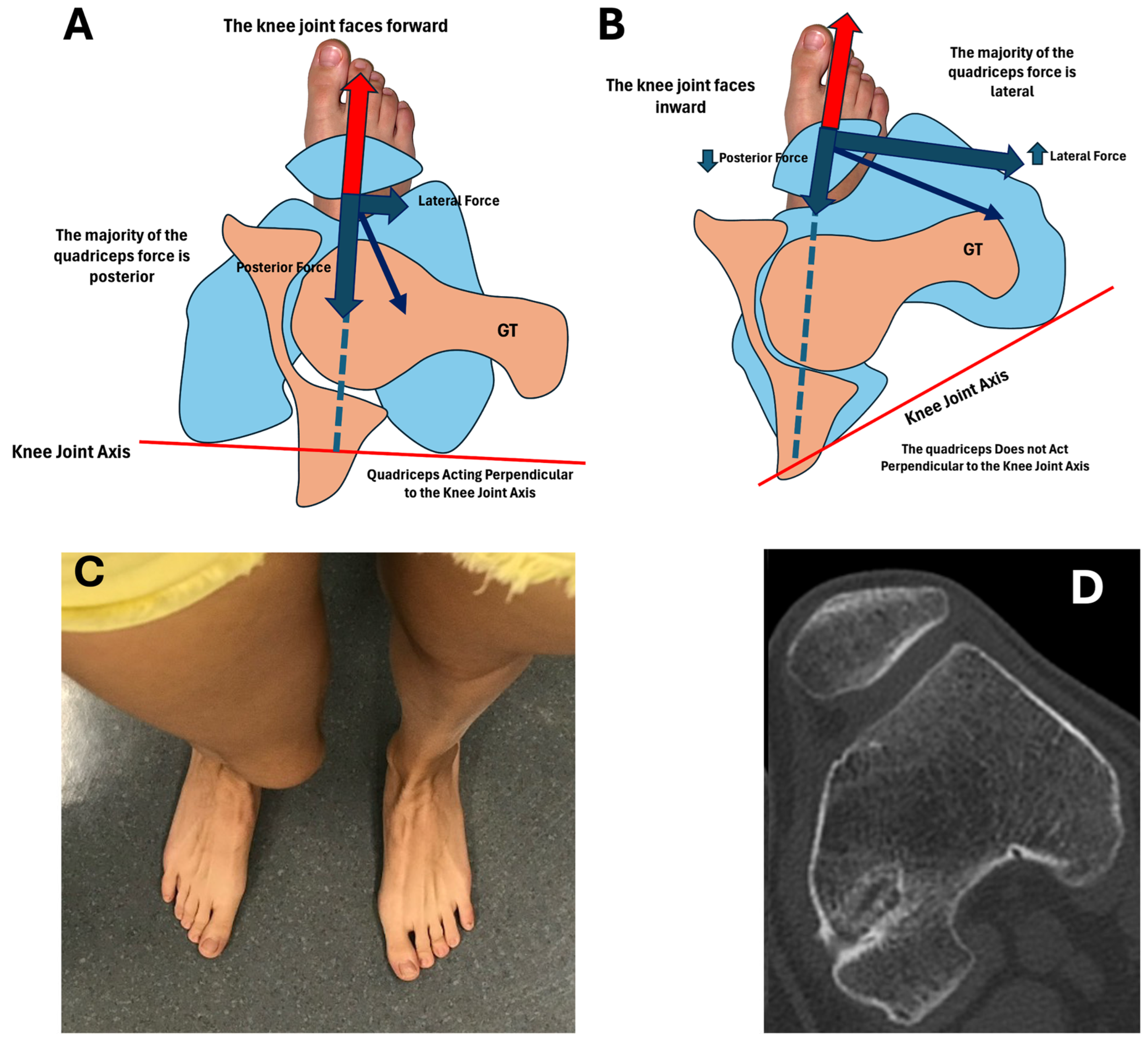 External Tibal Rotation Anterior Knee Pain and Excessive External Tibial Torsion in Female ...