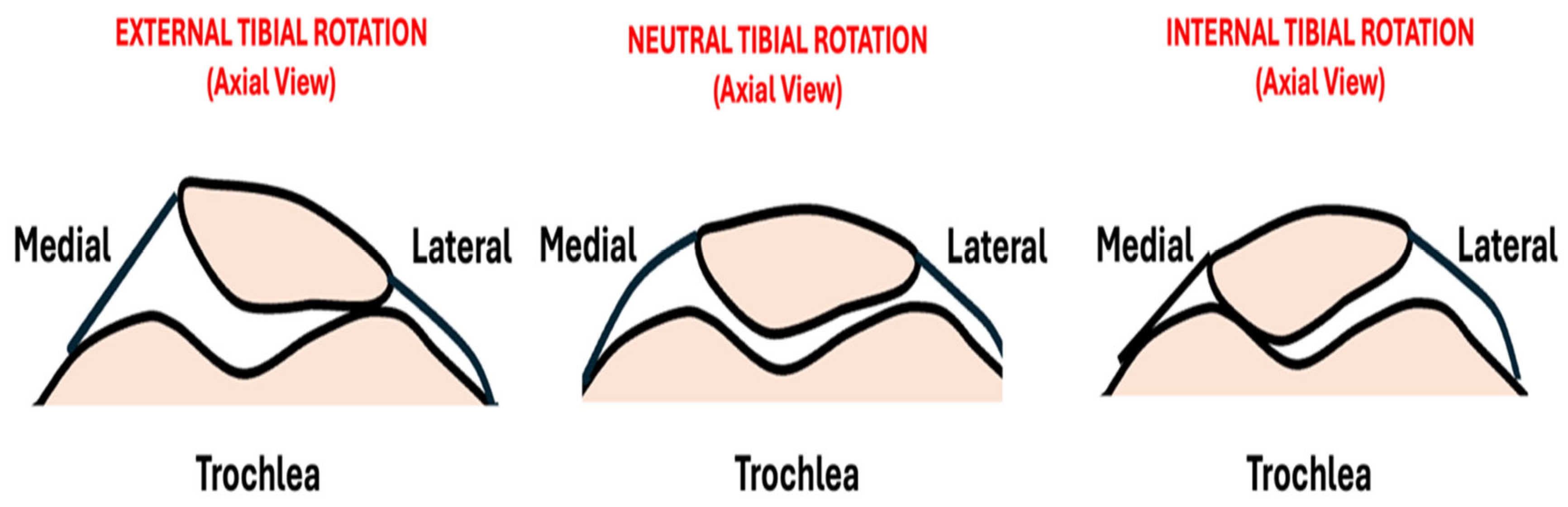 Tibia External Rotation Vs Normal Anterior Knee Pain and Excessive External Tibial Torsion in Female ...