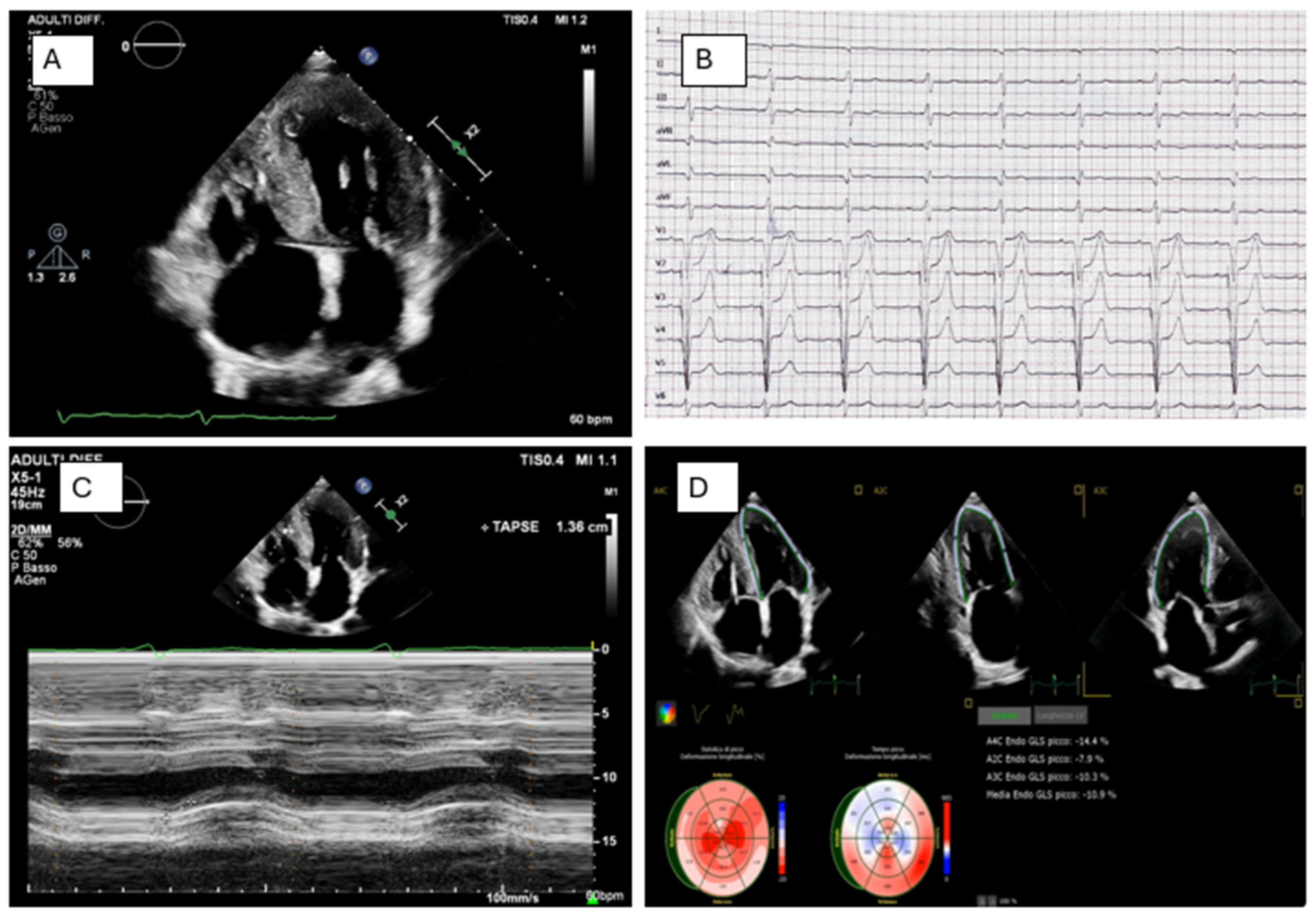 Revisiting the Genetics of Hypertrophic Cardiomyopathy: From Sarcomeres ...