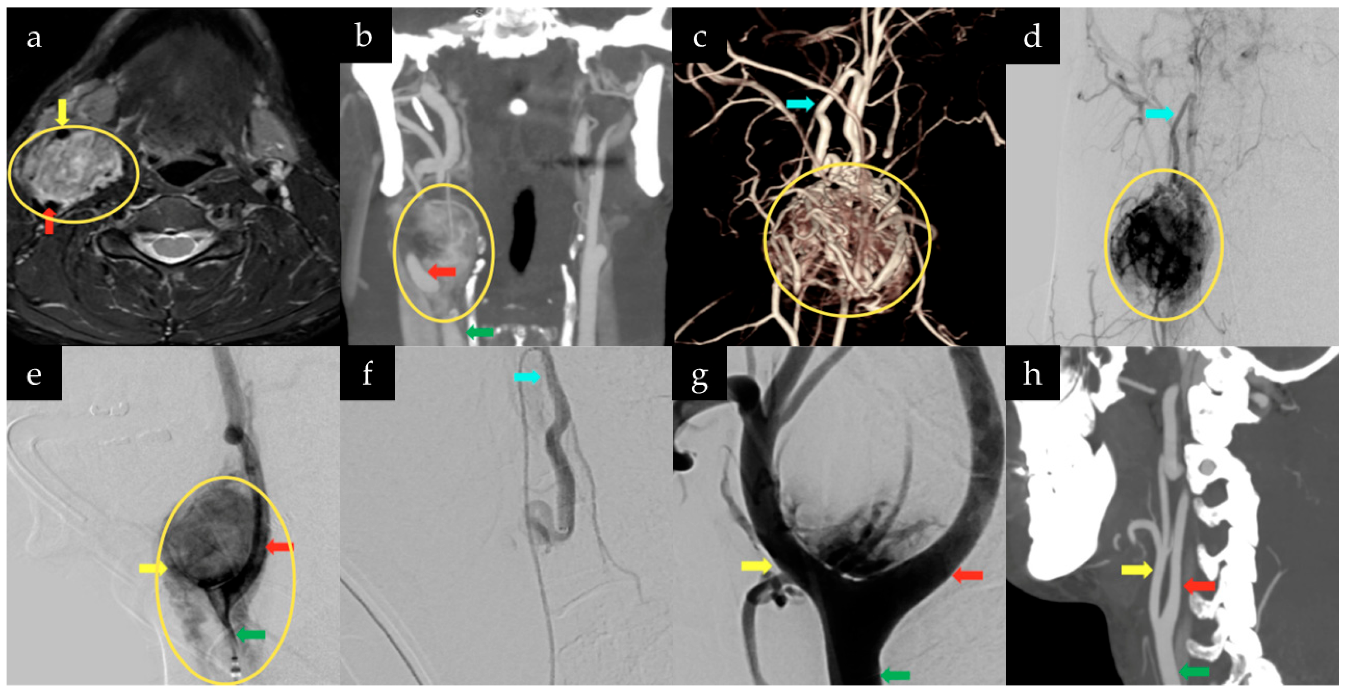 Microsurgical Management of Carotid Body Tumors: An Educational ...