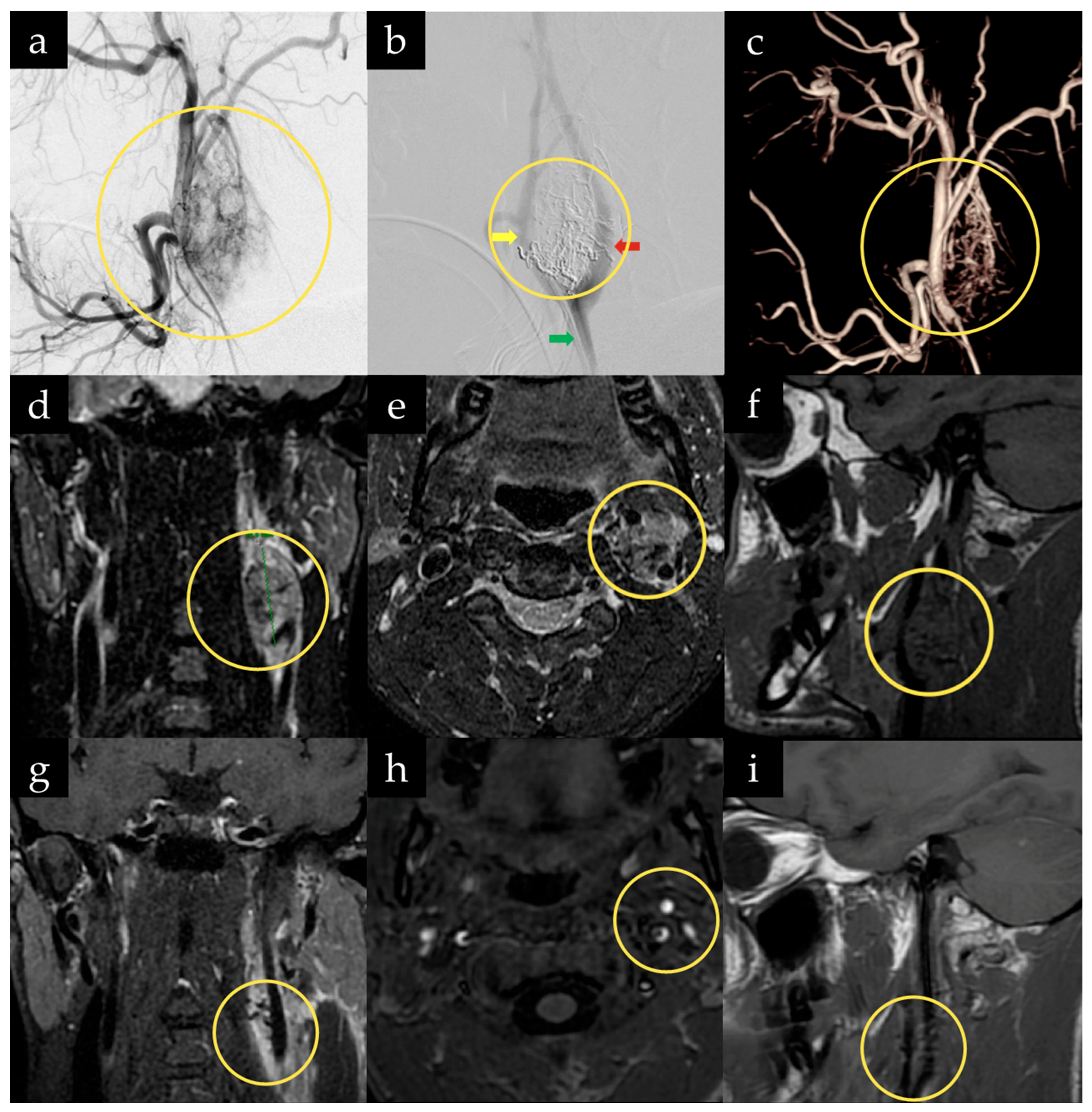 Microsurgical Management of Carotid Body Tumors: An Educational ...