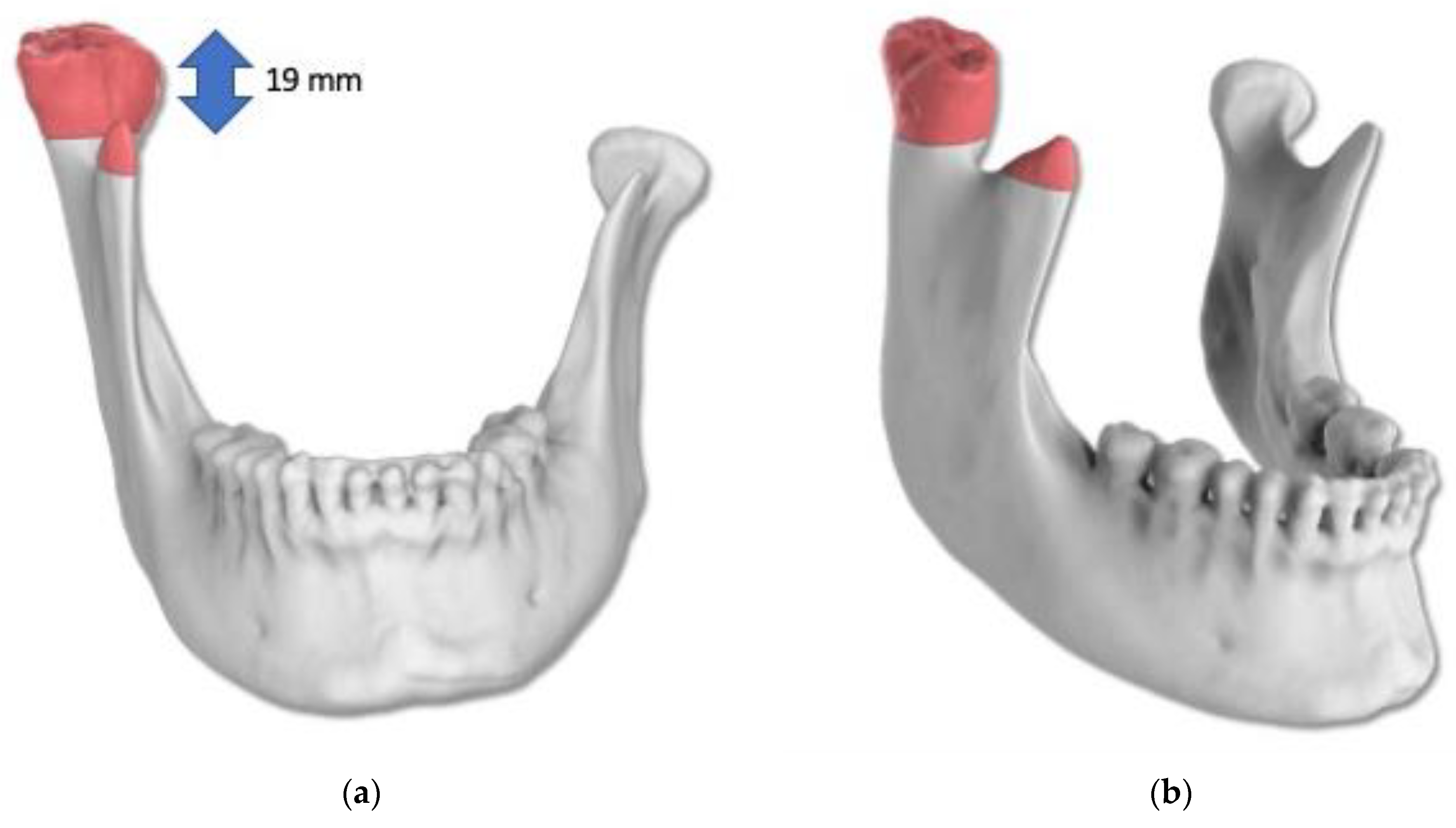 Condyle Lift Minimally Invasive Protocol for the Management of Unilateral Condylar ...
