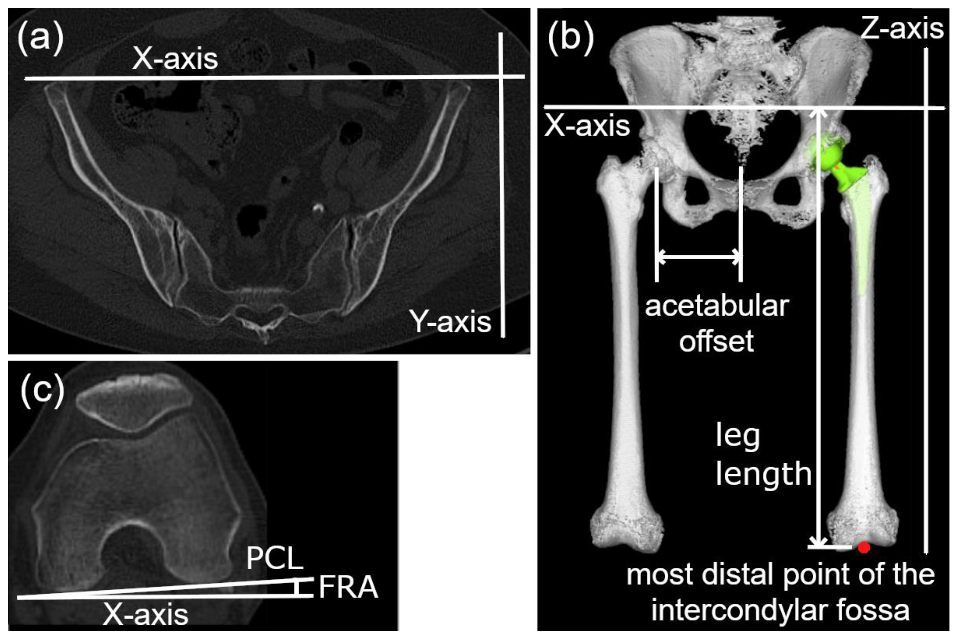 Postoperative Changes in Femoral Rotation Angle and Their Influencing ...
